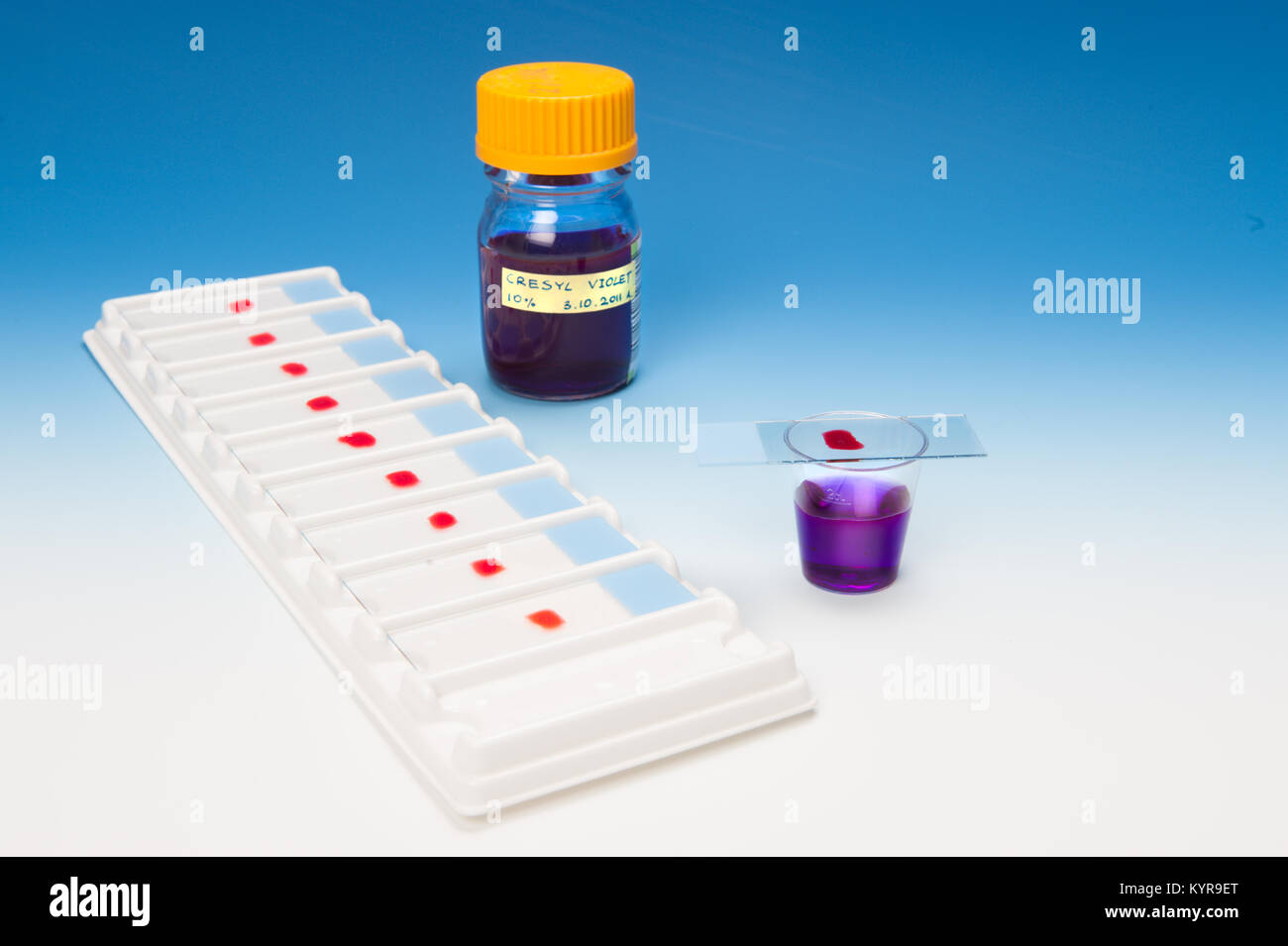 Les échantillons microscopiques Patient et solutions de coloration Banque D'Images