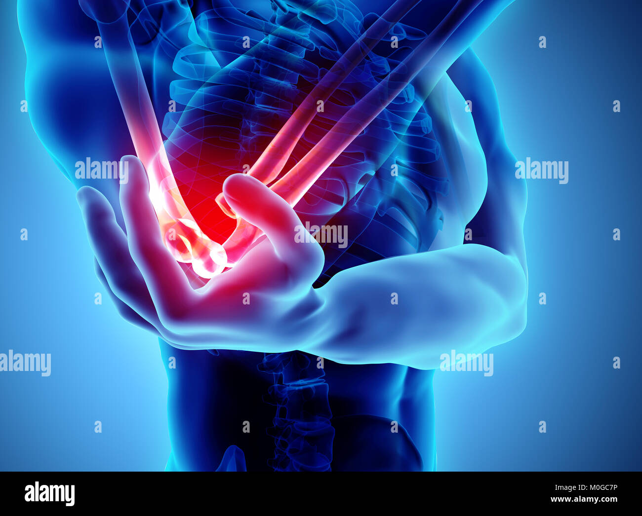 3d illustration de la blessure au coude, concept médical. Banque D'Images