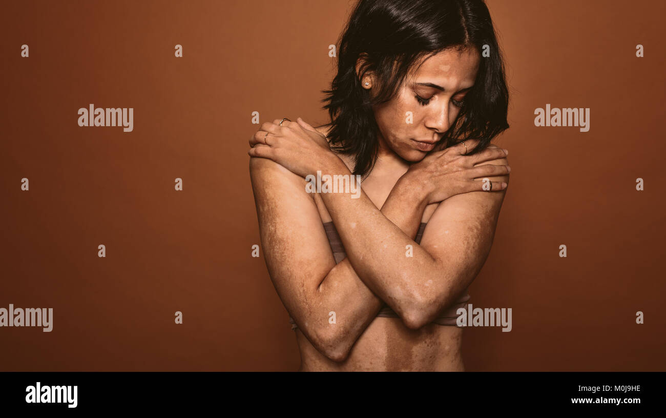 Jeune femme touchées par le vitiligo en studio. Femelle avec mauvais problème tan debout sur fond brun. Banque D'Images