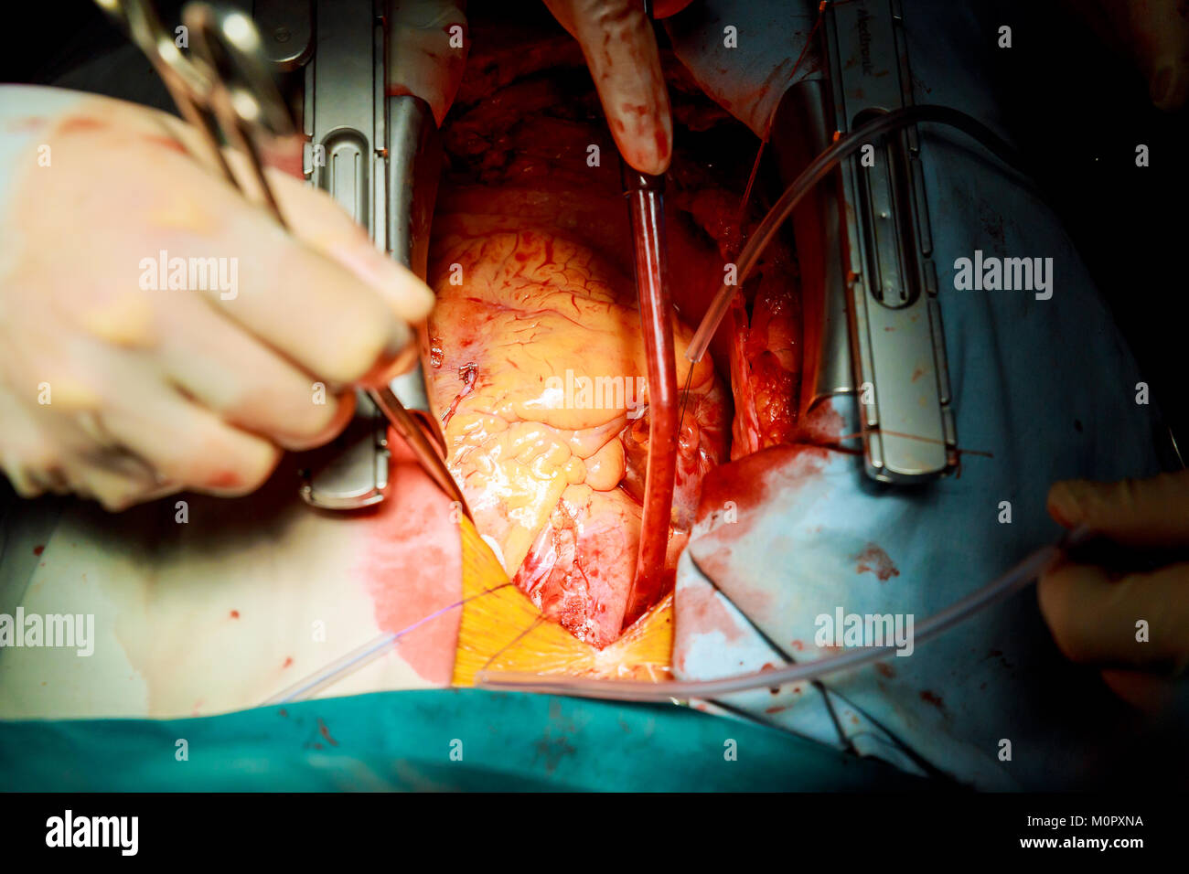 Coeur de l'homme au cours de la chirurgie cardiaque la transplantation. Poitrine vue chirurgien en chirurgie cardiaque les instruments chirurgicaux close-up Banque D'Images