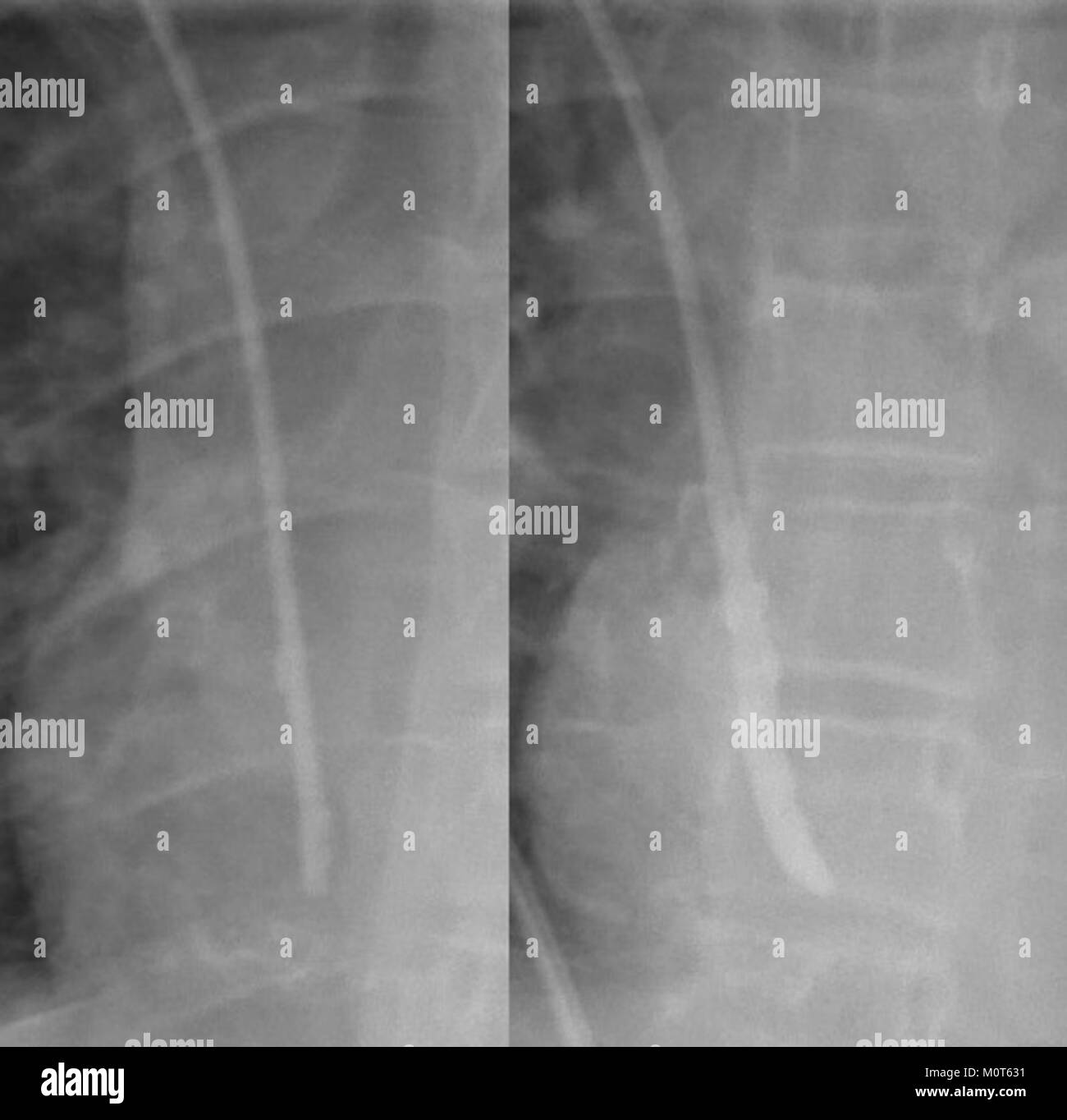 Cette image montre un cathéter veineux central avec une gaine de fibrine, un dispositif médical utilisé pour l'accès veineux, illustrant son rôle dans les soins aux patients et son importance dans les procédures cliniques. Banque D'Images