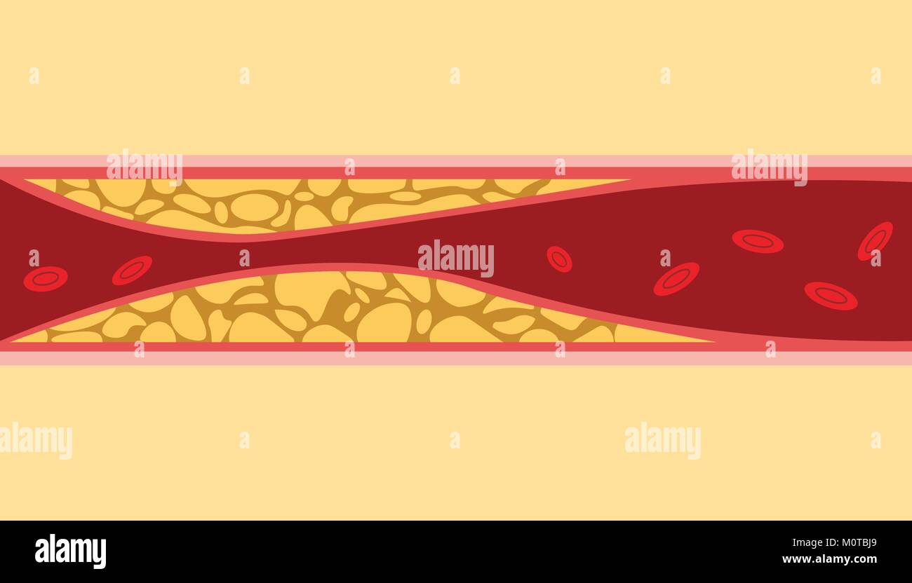 Le cholestérol sain de l'ONU des droits de l'écoulement de sang Cellules veine de graisse sur le côté avec une télévision illustration style Illustration de Vecteur