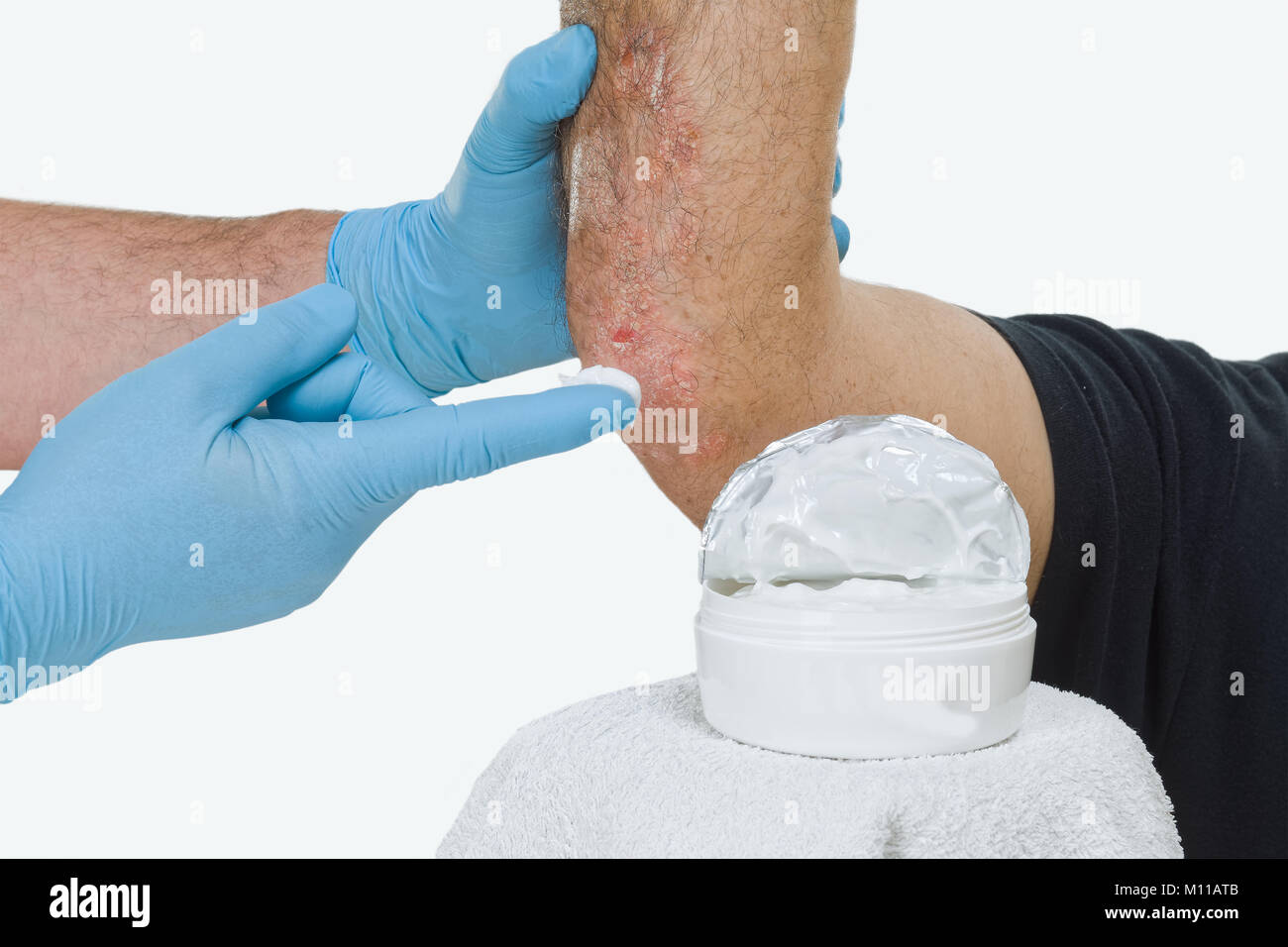Le psoriasis est une maladie inflammatoire chronique de la peau. Visites dermatologue le patient et propose une crème hydratante. Banque D'Images
