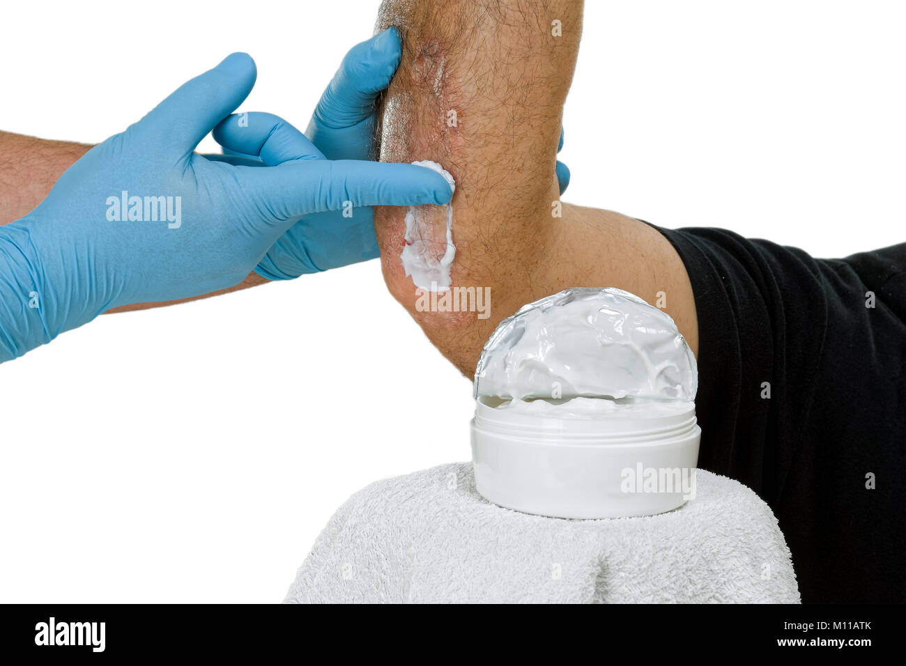 Le psoriasis est une maladie inflammatoire chronique de la peau. Visites dermatologue le patient et propose une crème hydratante. Banque D'Images