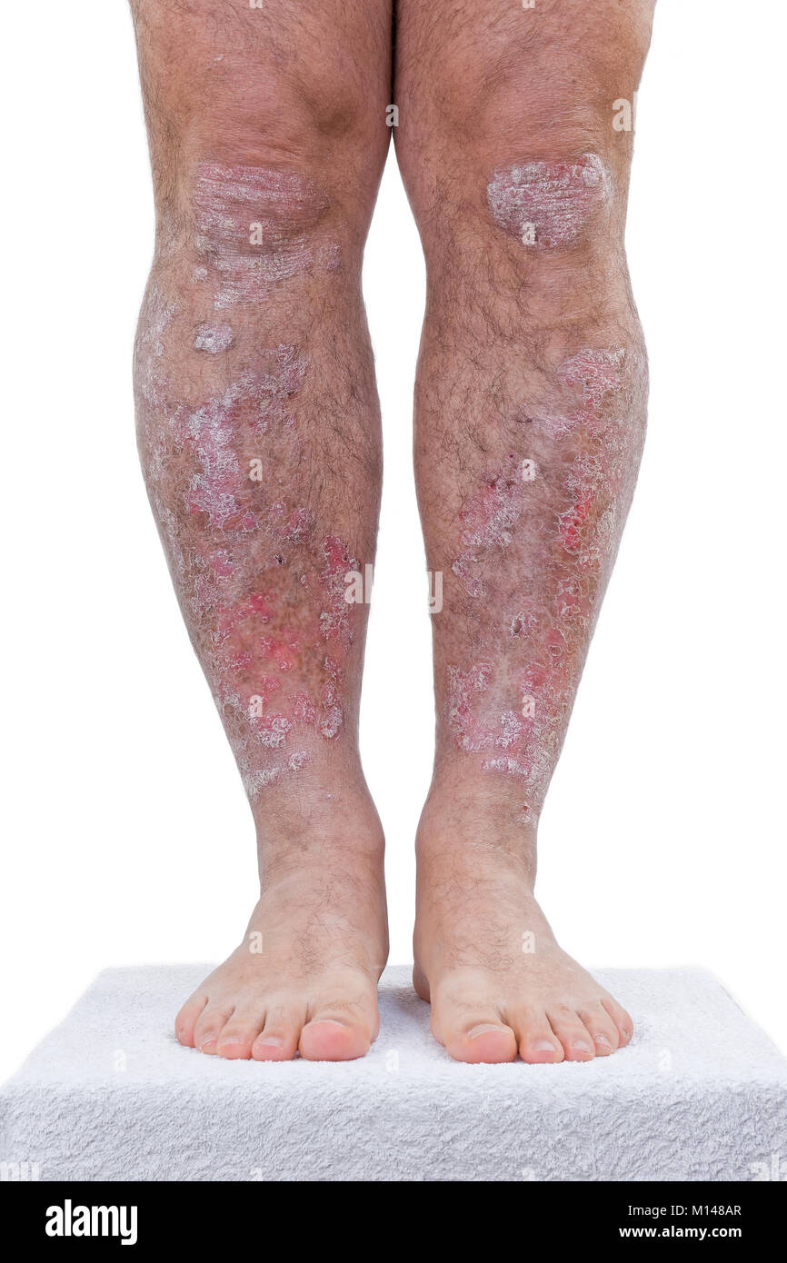 Le psoriasis est une maladie inflammatoire chronique de la peau. détails des jambes Photo Stock