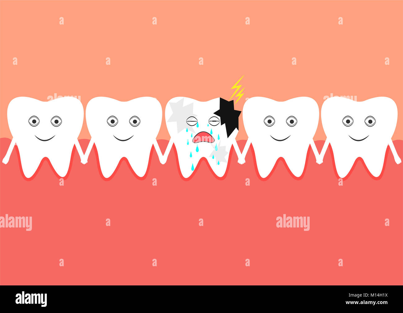 Santé des dents dont une est affectée par la carie. Degré lourd. Banque D'Images