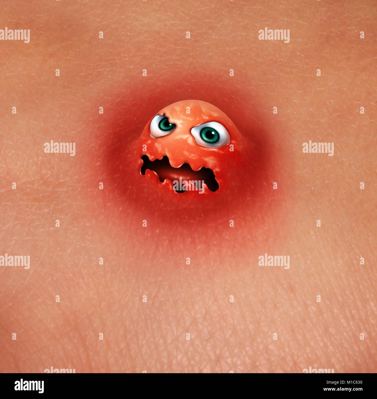 Monstre de bouton et une acné laid comme l'un des caractères de la santé de la peau dermatologie concept avec 3D illustration éléments. Banque D'Images