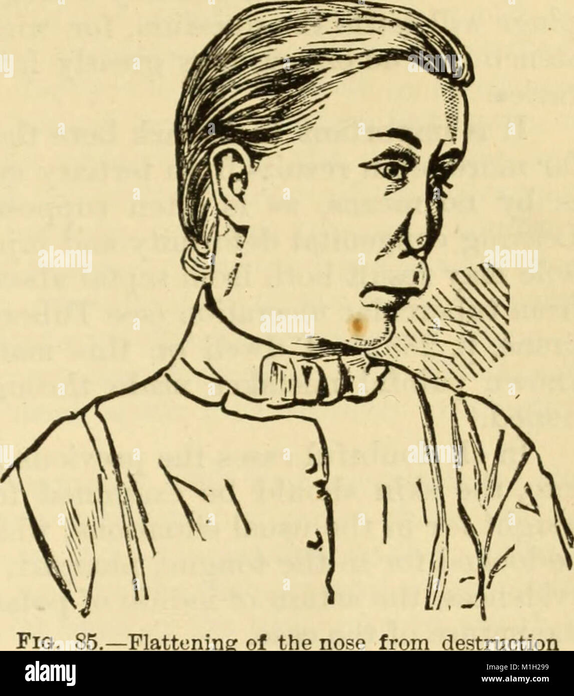 Ce manuel (1880) détaille le diagnostic et le traitement des maladies touchant la gorge et le nez, y compris le pharynx, le larynx, la trachée, l'œsophage, et naso-pharynx. Il fournit aux professionnels de la santé des informations cliniques détaillées sur les maladies respiratoires, offrant des méthodes pour identifier et traiter les affections liées aux voies respiratoires supérieures. Banque D'Images