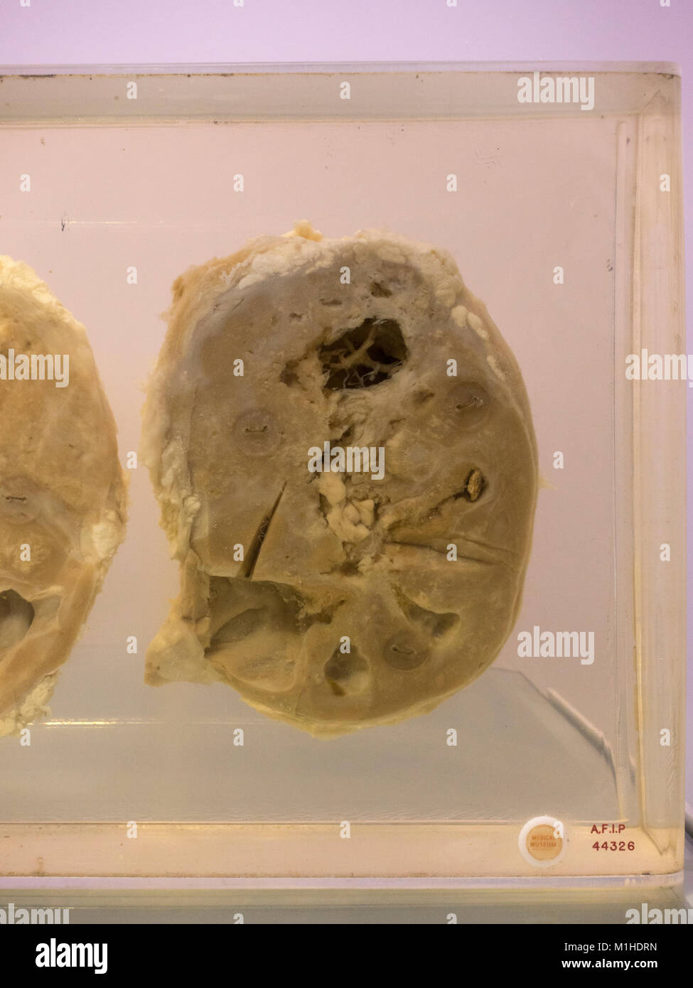 Un rein humain souffrant de carcinome spino-cellulaire sur l'affichage dans le Musée National de la santé et de la médecine, Silver Spring, MD, USA. Banque D'Images