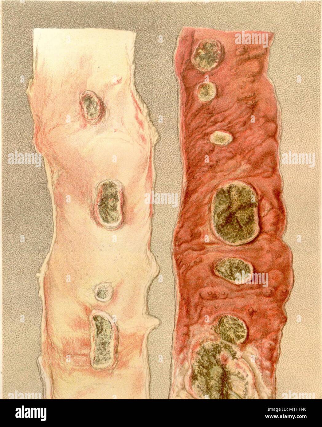 Illustration couleur induite par la fièvre typhoïde ulcérée de correctifs sur un dossier patient à partir de l'iléon, le volume "l'histoire médicale et chirurgicale de la guerre de la Rébellion, 1888. La partie III, Volume I (3e volume) médical rédigé par l' U.S. Army Medical Museum. Avec la permission de Internet Archive. () Banque D'Images