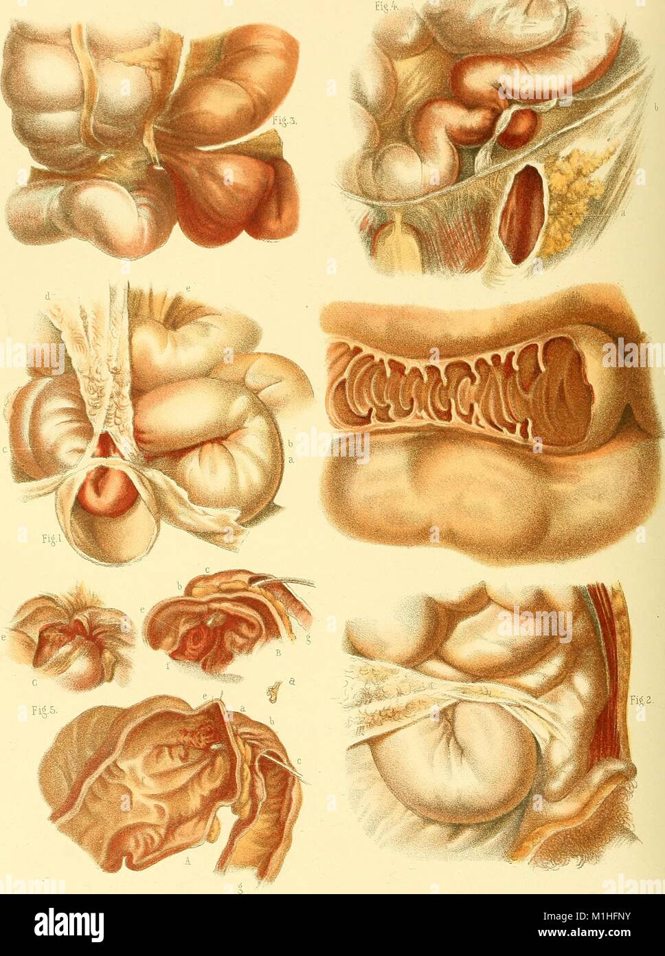 Illustration couleur représentant cinq cas de strangulation intestinale, avec des gros plans pour montrer les détails, à partir du volume "l'anatomie et le traitement chirurgical d'une hernie, ' rédigé par Henry O'Henry (Orlando) Marcy, 1892. Avec la permission de Internet Archive. () Banque D'Images