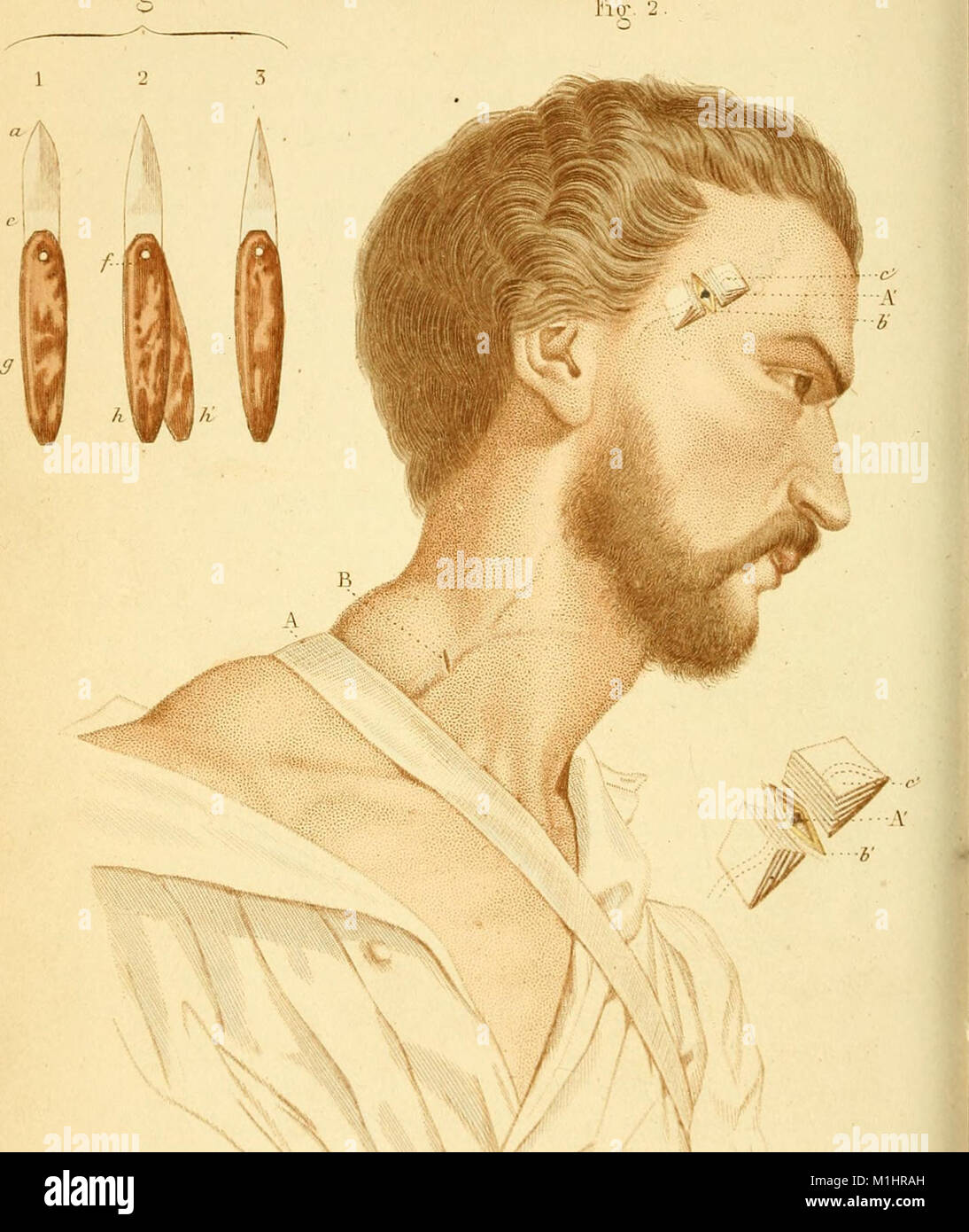 Chirurgie des maladies de l'oreille du nez, du pharynx, du larynx