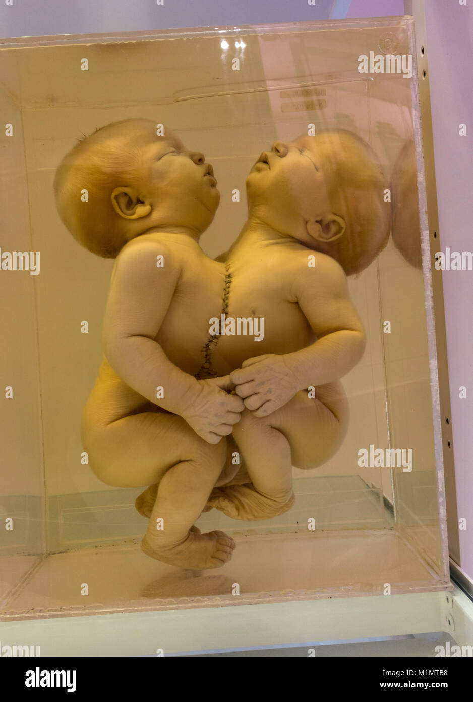 Une paire de jumeaux siamois d'une anomalie congénitale (thoracopagus) sur l'affichage dans le Musée National de la santé et de la médecine, Silver Spring, MD, USA. Banque D'Images