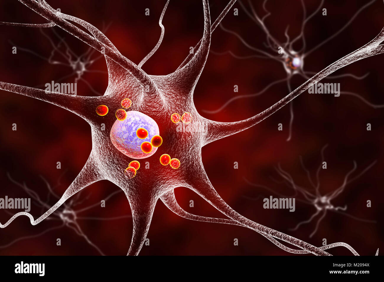 La maladie de Parkinson les cellules nerveuses. Illustration d'ordinateur des droits de cellules nerveuses touchées par Lewy (petites sphères rouges dans le cytoplasme des neurones) dans le cerveau d'un patient avec la maladie de Parkinson. Les corps de Lewy sont des accumulations anormales de protéines qui se développent à l'intérieur des cellules nerveuses dans la maladie de Parkinson, la démence à corps de Lewy, et d'autres troubles neurologiques. Banque D'Images