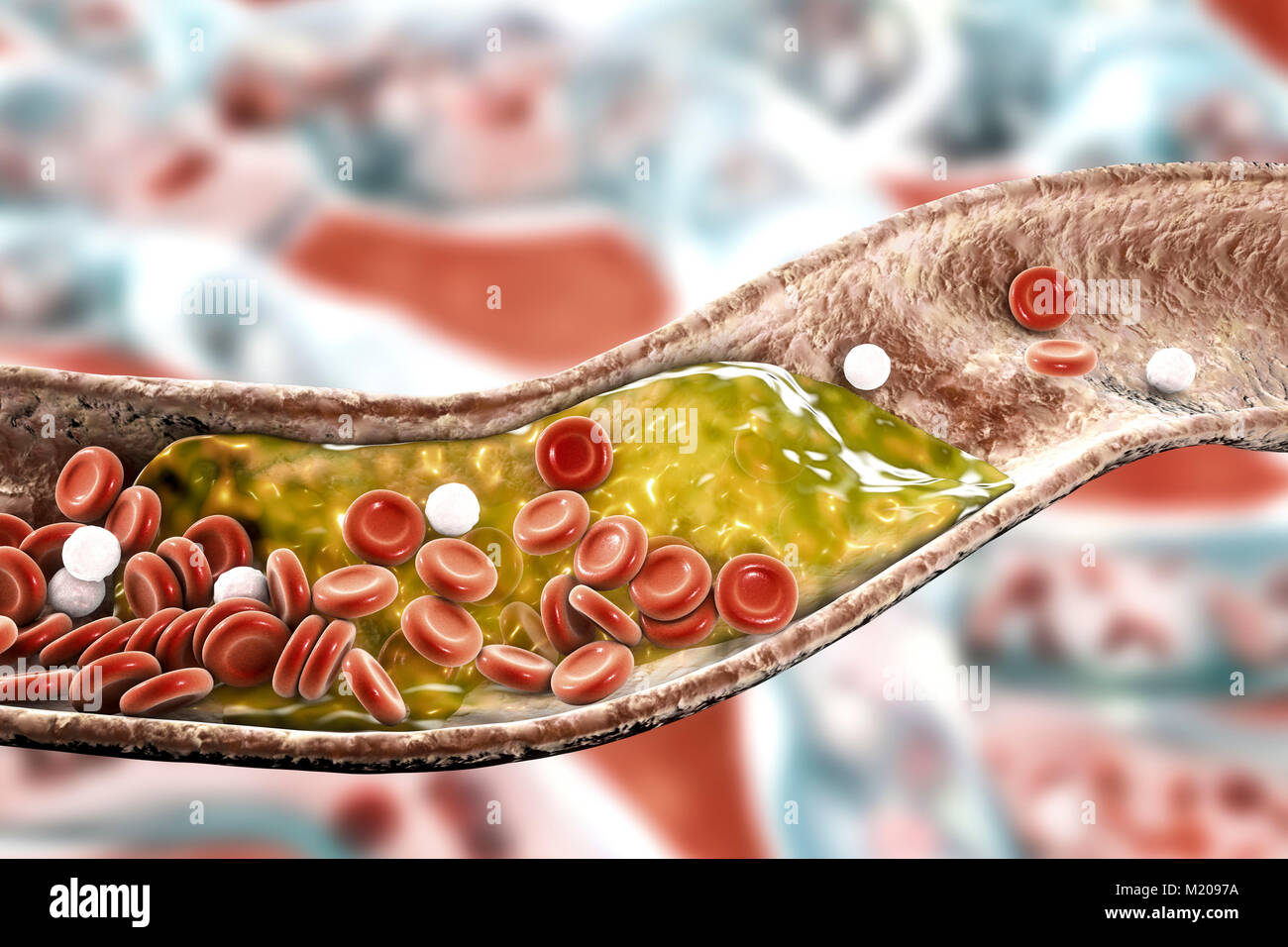 La plaque athéromateuse à l'intérieur des vaisseaux sanguins, l'illustration de l'ordinateur. Un taux de cholestérol de l'atheroma est à l'origine d'un rétrécissement des artères (athérosclérose). Banque D'Images