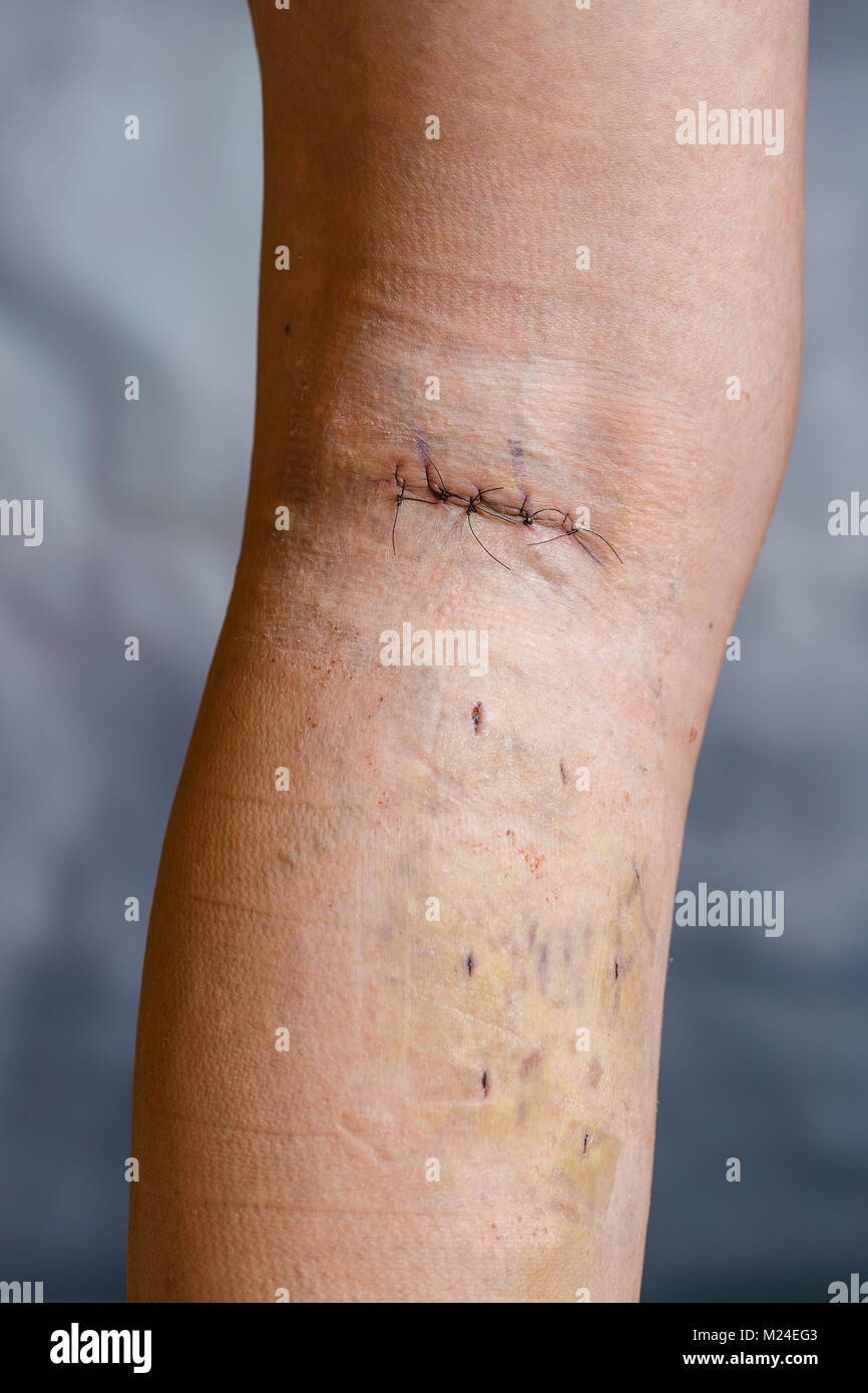 La jambe de womans après phlébectomie, avec sutures chirurgicales visibles (points de suture) et les blessures sur sa jambe. Le traitement curatif, procédures esthétiques, thrombose préc Banque D'Images