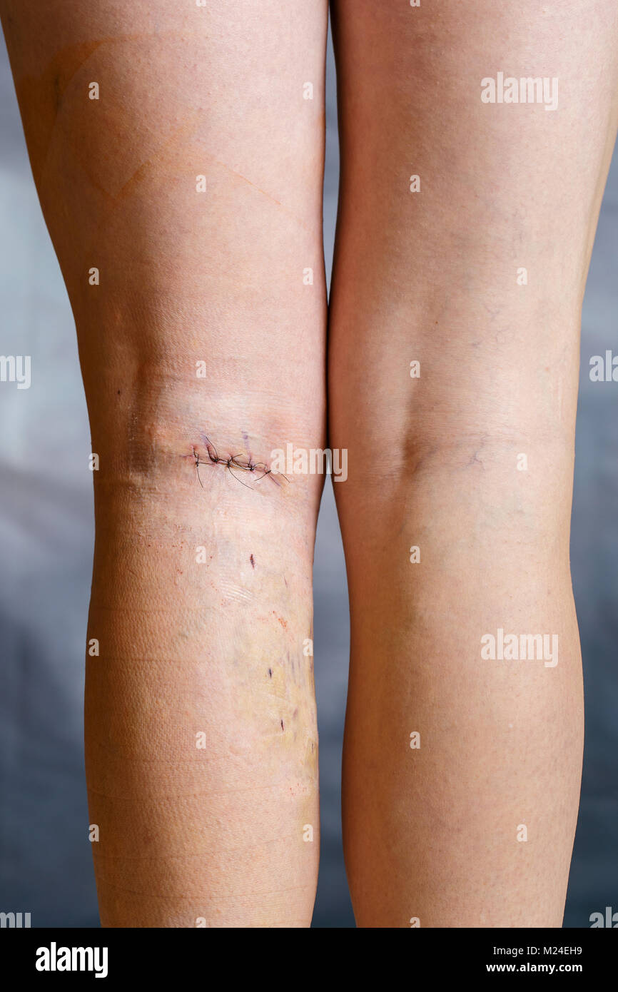 Les jambes de womans après chirurgie des varices visibles, avec des sutures chirurgicales (suture) et les blessures sur une jambe. Le traitement curatif, procédures esthétiques, thr Banque D'Images