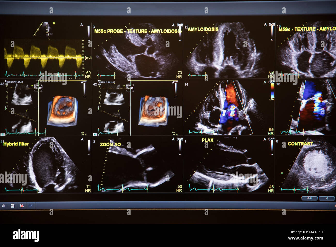 L'échographie cardiaque image sur un écran d'ordinateur. Banque D'Images