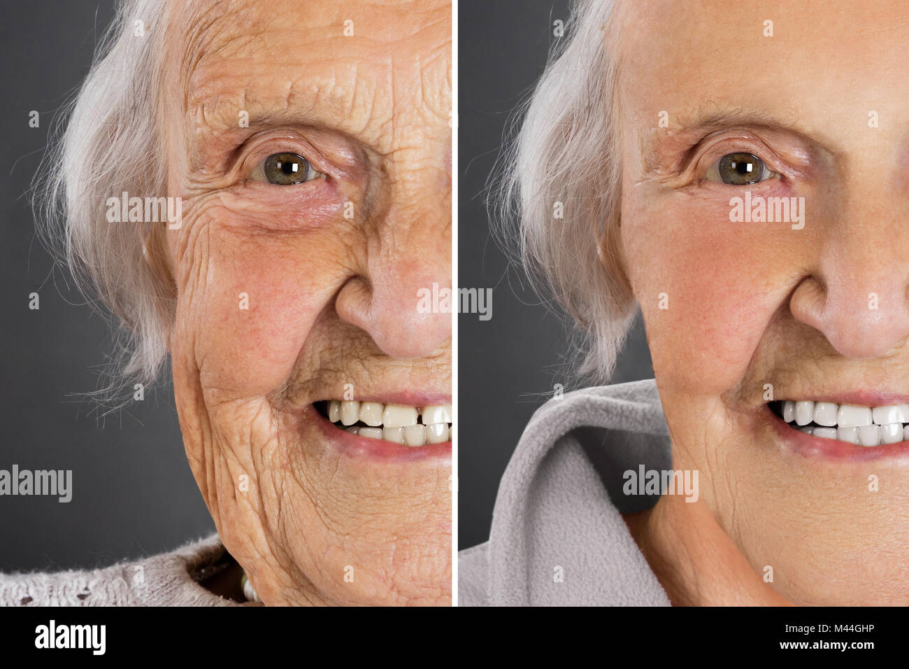 Senior woman anti vieillissement peau avant et après traitement Banque D'Images