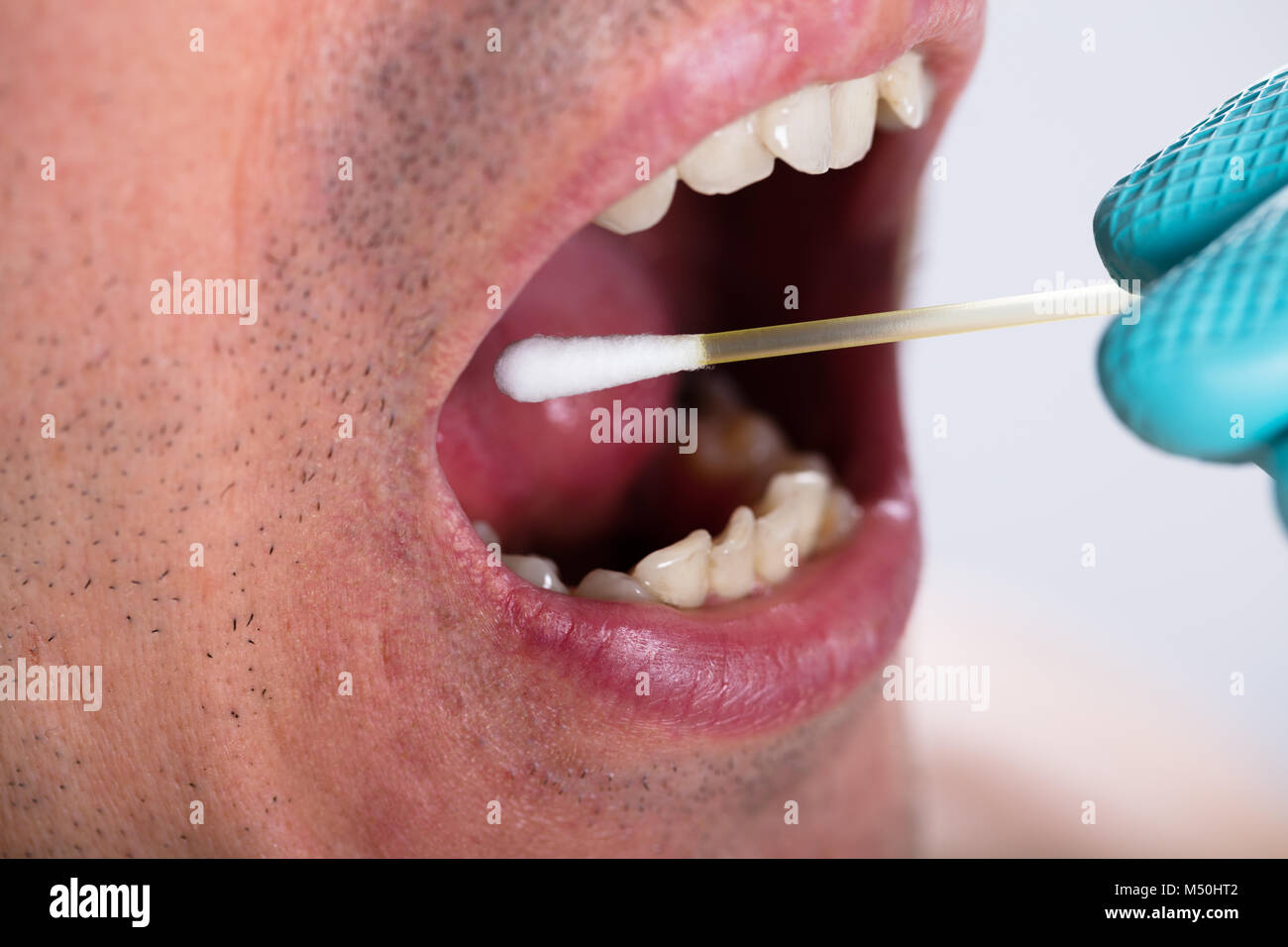 Close-up de dentiste part faire de test de salive sur la bouche avec du coton-tige Banque D'Images