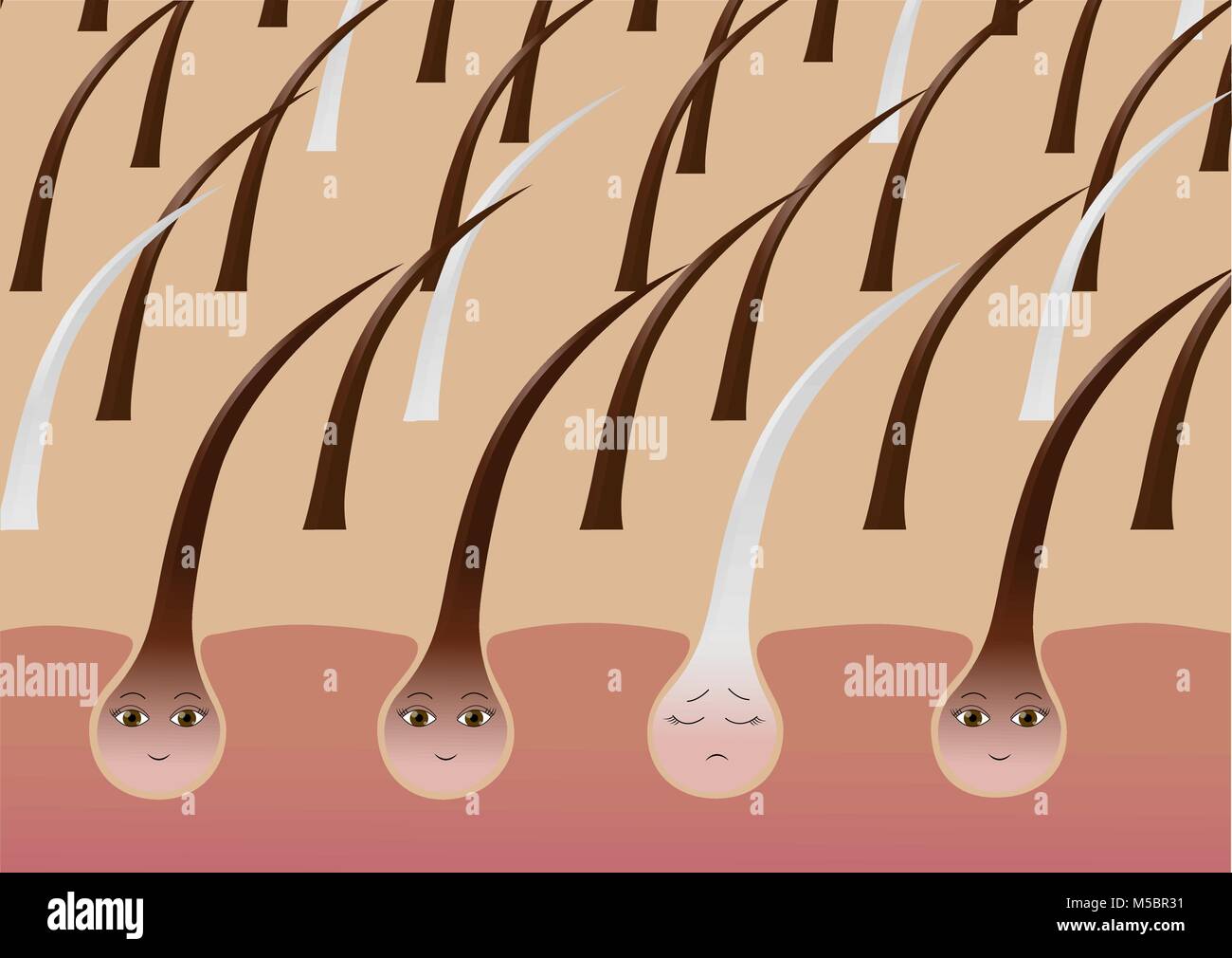 Cartoon follicules de cheveux sur le cuir chevelu souffrant de la pigmentation Illustration de Vecteur