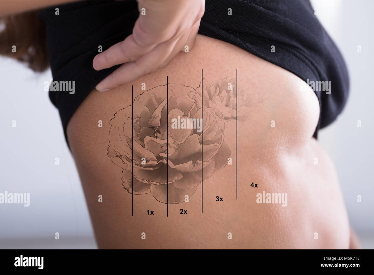 Laser tattoo removal Banque de photographies et d'images à haute résolution  - Alamy