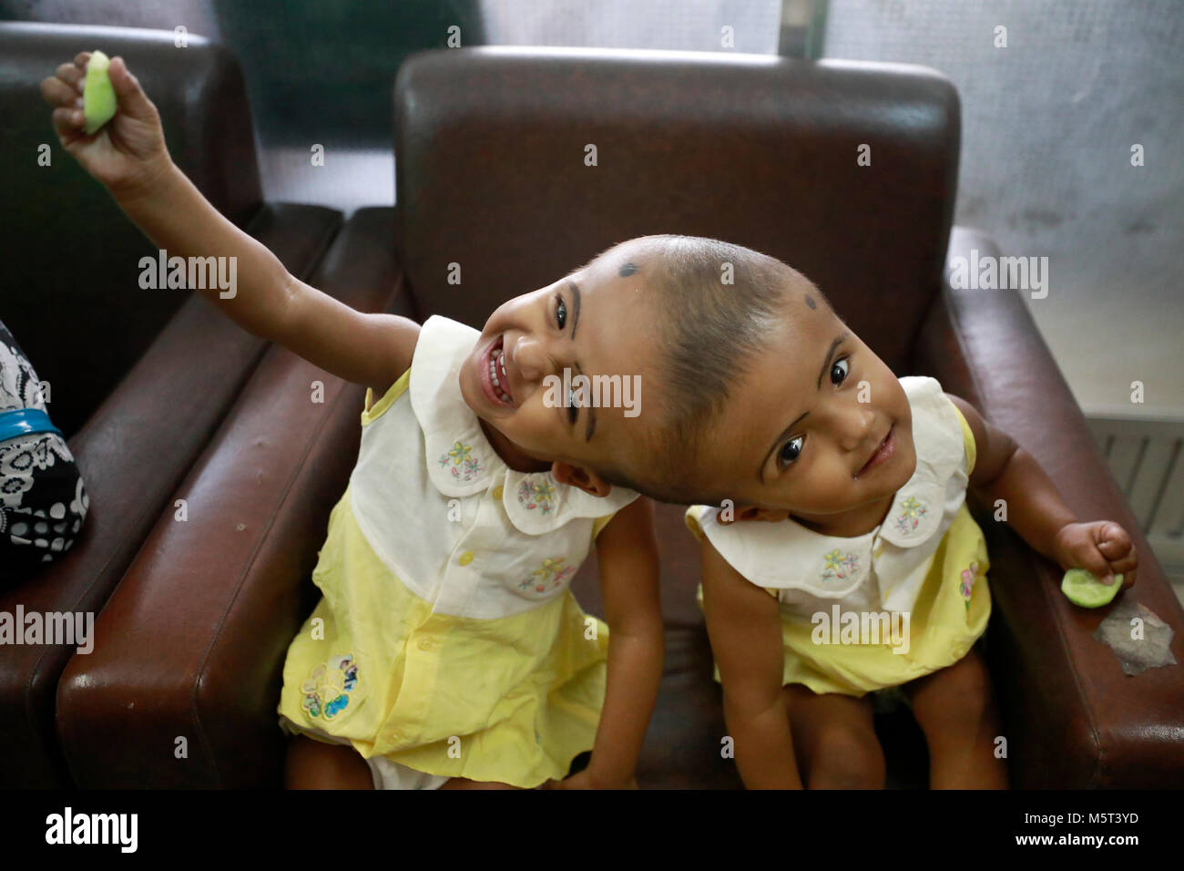 Dhaka, Bangladesh. 26 Février, 2018. Lits jumeaux siamois filles Rabeya l'Islam et l'Islam Rokeya jouer dans un hôpital à Dhaka, au Bangladesh. Taslima Khatun, professeur d'école, a donné une naissance de jumeaux siamois le dirigé le 16 juillet 2016 après une césarienne. Les jumeaux ont été admis à Dhaka medical college hospital pour examen avant la chirurgie potentiellement à séparer leurs têtes. Credit : SK Hasan Ali/Alamy Live News Banque D'Images