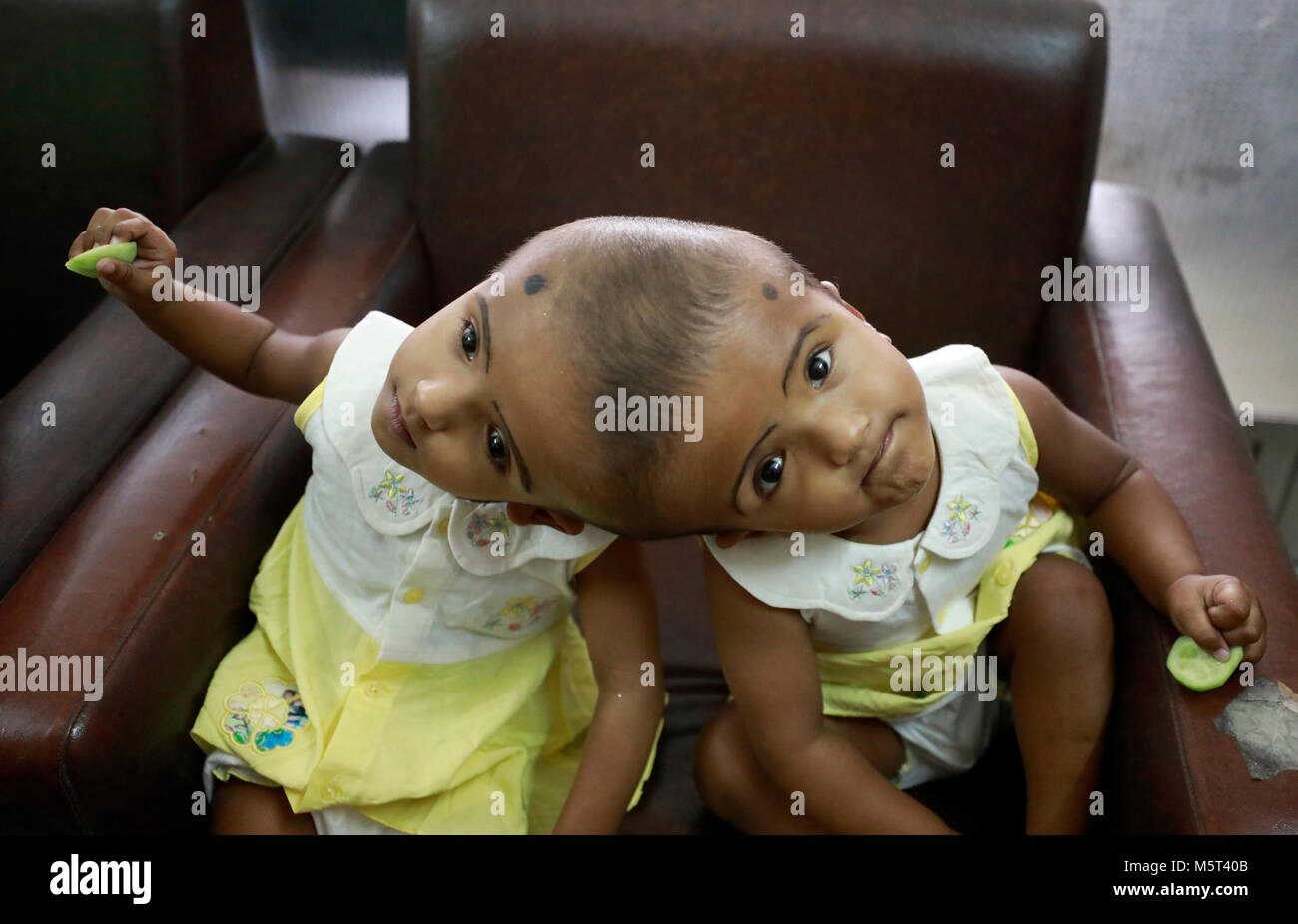 Dhaka, Bangladesh. 26 Février, 2018. Lits jumeaux siamois filles Rabeya l'Islam et l'Islam Rokeya jouer dans un hôpital à Dhaka, au Bangladesh. Taslima Khatun, professeur d'école, a donné une naissance de jumeaux siamois le dirigé le 16 juillet 2016 après une césarienne. Les jumeaux ont été admis à Dhaka medical college hospital pour examen avant la chirurgie potentiellement à séparer leurs têtes. Credit : SK Hasan Ali/Alamy Live News Banque D'Images