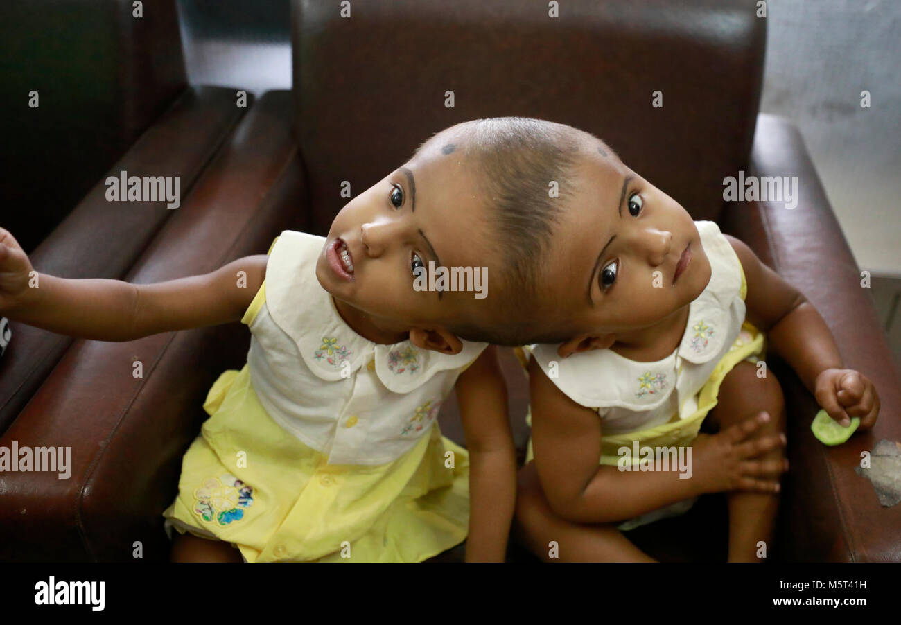 Dhaka, Bangladesh. 26 Février, 2018. Lits jumeaux siamois filles Rabeya l'Islam et l'Islam Rokeya jouer dans un hôpital à Dhaka, au Bangladesh. Taslima Khatun, professeur d'école, a donné une naissance de jumeaux siamois le dirigé le 16 juillet 2016 après une césarienne. Les jumeaux ont été admis à Dhaka medical college hospital pour examen avant la chirurgie potentiellement à séparer leurs têtes. Credit : SK Hasan Ali/Alamy Live News Banque D'Images