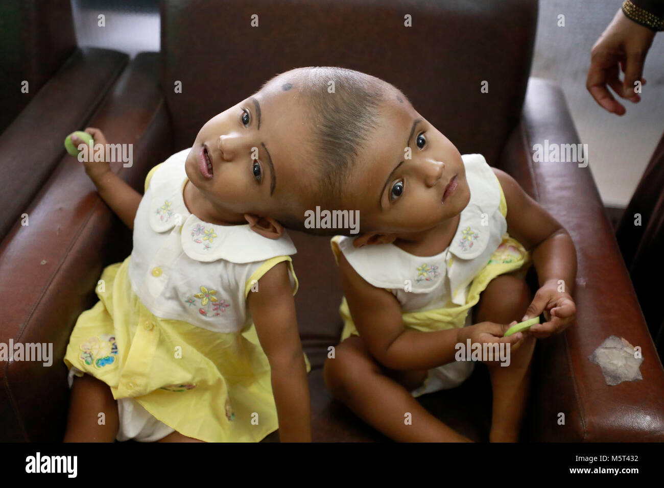 Dhaka, Bangladesh. 26 Février, 2018. Lits jumeaux siamois filles Rabeya l'Islam et l'Islam Rokeya jouer dans un hôpital à Dhaka, au Bangladesh. Taslima Khatun, professeur d'école, a donné une naissance de jumeaux siamois le dirigé le 16 juillet 2016 après une césarienne. Les jumeaux ont été admis à Dhaka medical college hospital pour examen avant la chirurgie potentiellement à séparer leurs têtes. Credit : SK Hasan Ali/Alamy Live News Banque D'Images