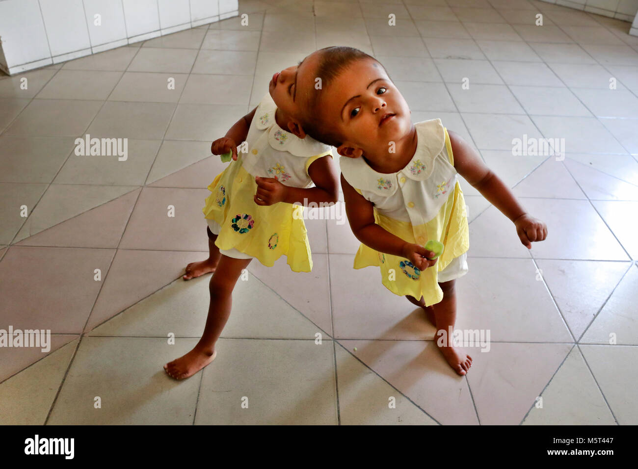 Dhaka, Bangladesh. 26 Février, 2018. Lits jumeaux siamois filles Rabeya l'Islam et l'Islam Rokeya jouer dans un hôpital à Dhaka, au Bangladesh. Taslima Khatun, professeur d'école, a donné une naissance de jumeaux siamois le dirigé le 16 juillet 2016 après une césarienne. Les jumeaux ont été admis à Dhaka medical college hospital pour examen avant la chirurgie potentiellement à séparer leurs têtes. Credit : SK Hasan Ali/Alamy Live News Banque D'Images
