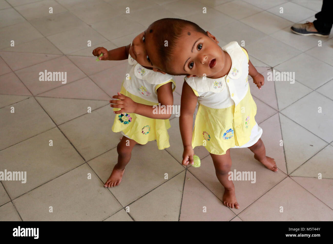 Dhaka, Bangladesh. 26 Février, 2018. Lits jumeaux siamois filles Rabeya l'Islam et l'Islam Rokeya jouer dans un hôpital à Dhaka, au Bangladesh. Taslima Khatun, professeur d'école, a donné une naissance de jumeaux siamois le dirigé le 16 juillet 2016 après une césarienne. Les jumeaux ont été admis à Dhaka medical college hospital pour examen avant la chirurgie potentiellement à séparer leurs têtes. Credit : SK Hasan Ali/Alamy Live News Banque D'Images