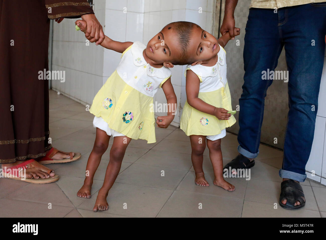 Dhaka, Bangladesh. 26 Février, 2018. Lits jumeaux siamois filles Rabeya l'Islam et l'Islam Rokeya jouer dans un hôpital à Dhaka, au Bangladesh. Taslima Khatun, professeur d'école, a donné une naissance de jumeaux siamois le dirigé le 16 juillet 2016 après une césarienne. Les jumeaux ont été admis à Dhaka medical college hospital pour examen avant la chirurgie potentiellement à séparer leurs têtes. Credit : SK Hasan Ali/Alamy Live News Banque D'Images