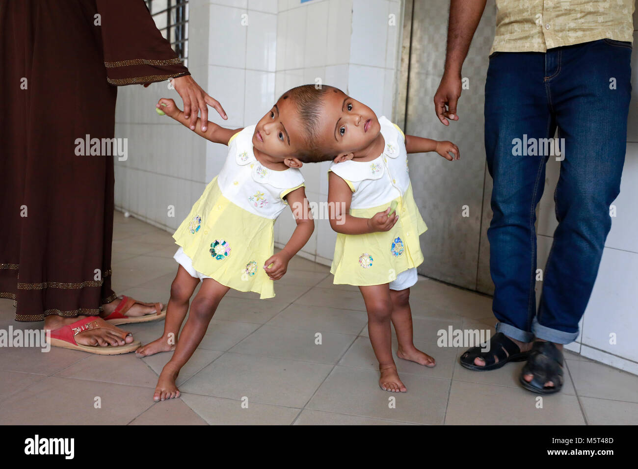 Dhaka, Bangladesh. 26 Février, 2018. Lits jumeaux siamois filles Rabeya l'Islam et l'Islam Rokeya jouer dans un hôpital à Dhaka, au Bangladesh. Taslima Khatun, professeur d'école, a donné une naissance de jumeaux siamois le dirigé le 16 juillet 2016 après une césarienne. Les jumeaux ont été admis à Dhaka medical college hospital pour examen avant la chirurgie potentiellement à séparer leurs têtes. Credit : SK Hasan Ali/Alamy Live News Banque D'Images