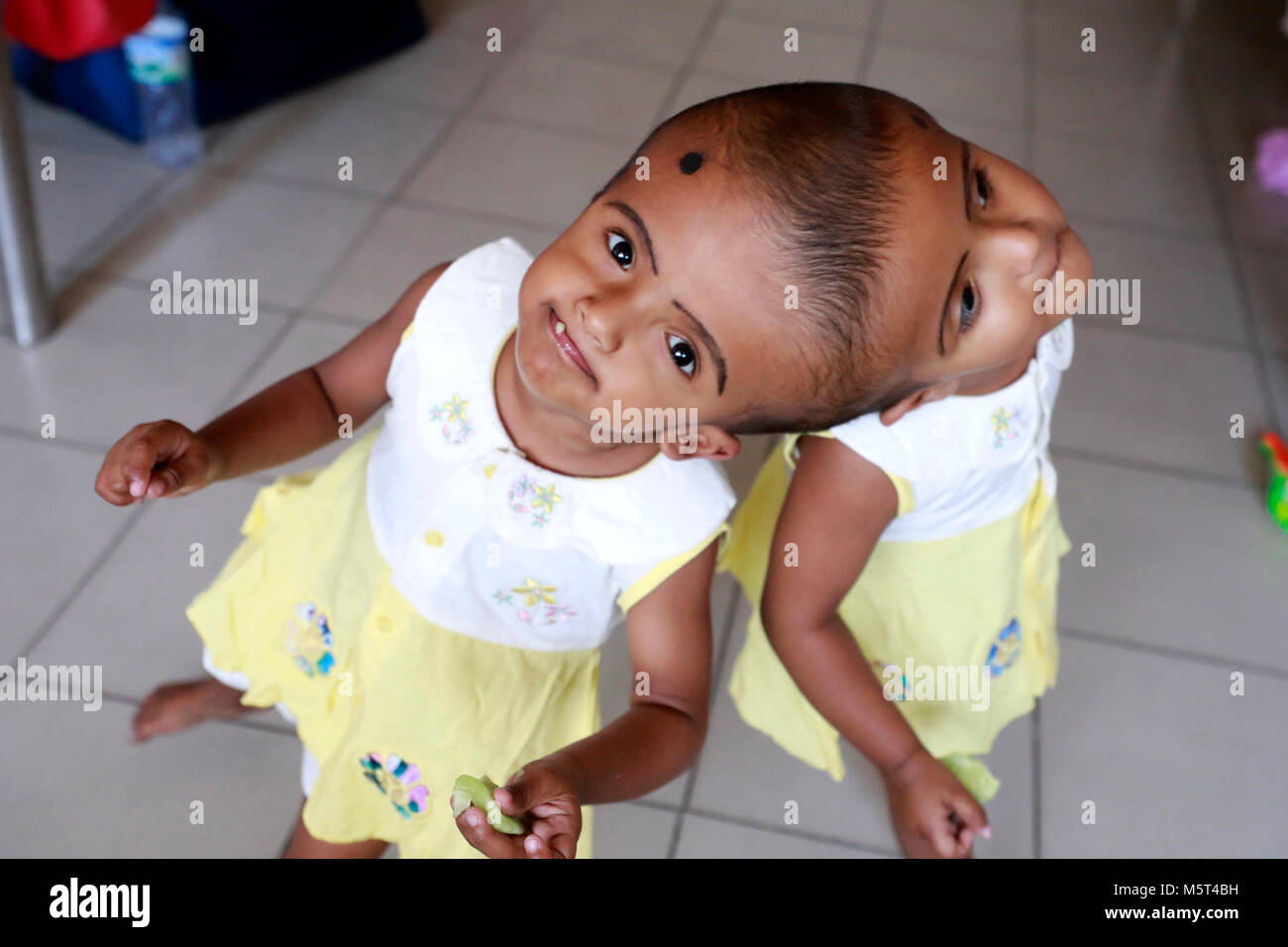 Dhaka, Bangladesh. 26 Février, 2018. Lits jumeaux siamois filles Rabeya l'Islam et l'Islam Rokeya jouer dans un hôpital à Dhaka, au Bangladesh. Taslima Khatun, professeur d'école, a donné une naissance de jumeaux siamois le dirigé le 16 juillet 2016 après une césarienne. Les jumeaux ont été admis à Dhaka medical college hospital pour examen avant la chirurgie potentiellement à séparer leurs têtes. Credit : SK Hasan Ali/Alamy Live News Banque D'Images