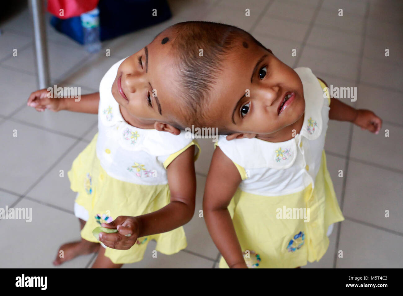 Dhaka, Bangladesh. 26 Février, 2018. Lits jumeaux siamois filles Rabeya l'Islam et l'Islam Rokeya jouer dans un hôpital à Dhaka, au Bangladesh. Taslima Khatun, professeur d'école, a donné une naissance de jumeaux siamois le dirigé le 16 juillet 2016 après une césarienne. Les jumeaux ont été admis à Dhaka medical college hospital pour examen avant la chirurgie potentiellement à séparer leurs têtes. Credit : SK Hasan Ali/Alamy Live News Banque D'Images
