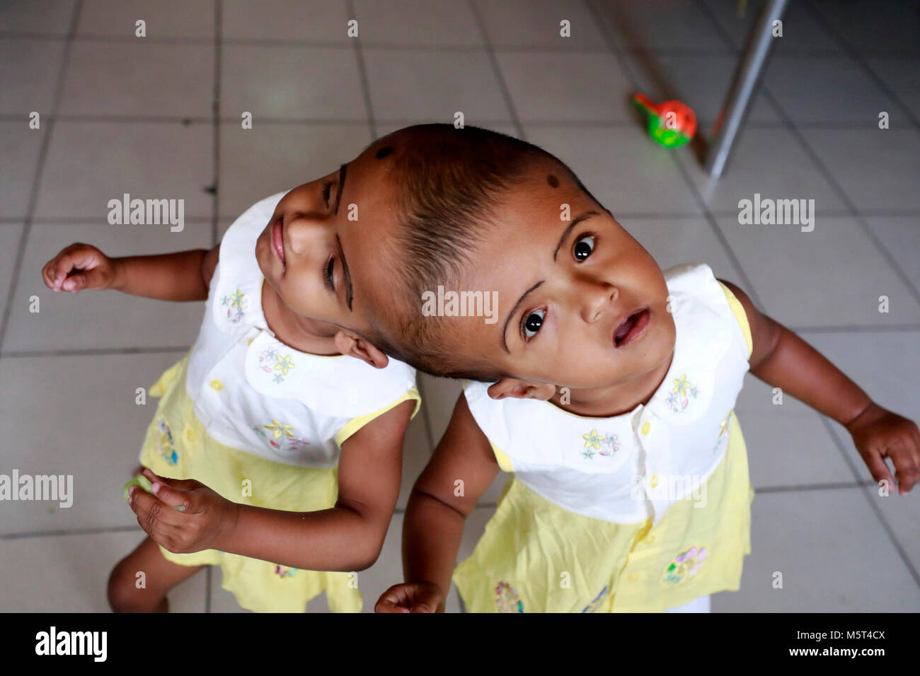 Dhaka, Bangladesh. 26 Février, 2018. Lits jumeaux siamois filles Rabeya l'Islam et l'Islam Rokeya jouer dans un hôpital à Dhaka, au Bangladesh. Taslima Khatun, professeur d'école, a donné une naissance de jumeaux siamois le dirigé le 16 juillet 2016 après une césarienne. Les jumeaux ont été admis à Dhaka medical college hospital pour examen avant la chirurgie potentiellement à séparer leurs têtes. Credit : SK Hasan Ali/Alamy Live News Banque D'Images
