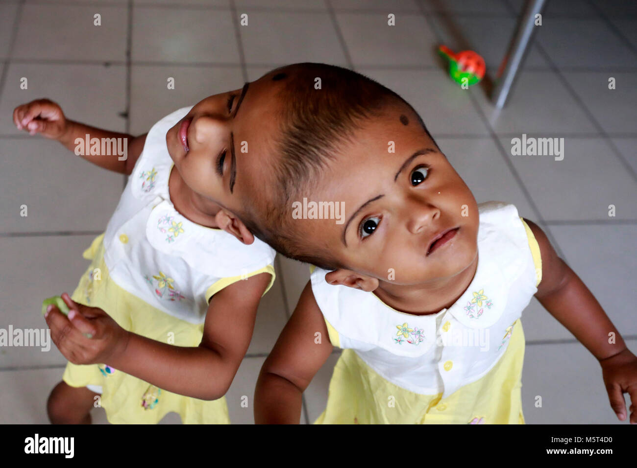 Dhaka, Bangladesh. 26 Février, 2018. Lits jumeaux siamois filles Rabeya l'Islam et l'Islam Rokeya jouer dans un hôpital à Dhaka, au Bangladesh. Taslima Khatun, professeur d'école, a donné une naissance de jumeaux siamois le dirigé le 16 juillet 2016 après une césarienne. Les jumeaux ont été admis à Dhaka medical college hospital pour examen avant la chirurgie potentiellement à séparer leurs têtes. Credit : SK Hasan Ali/Alamy Live News Banque D'Images