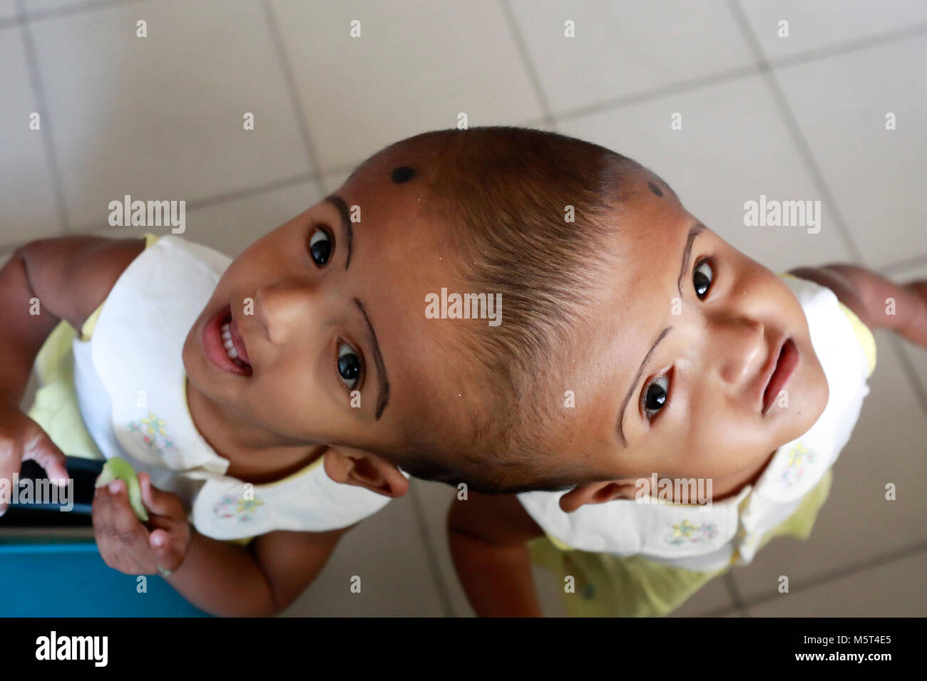 Dhaka, Bangladesh. 26 Février, 2018. Lits jumeaux siamois filles Rabeya l'Islam et l'Islam Rokeya jouer dans un hôpital à Dhaka, au Bangladesh. Taslima Khatun, professeur d'école, a donné une naissance de jumeaux siamois le dirigé le 16 juillet 2016 après une césarienne. Les jumeaux ont été admis à Dhaka medical college hospital pour examen avant la chirurgie potentiellement à séparer leurs têtes. Credit : SK Hasan Ali/Alamy Live News Banque D'Images