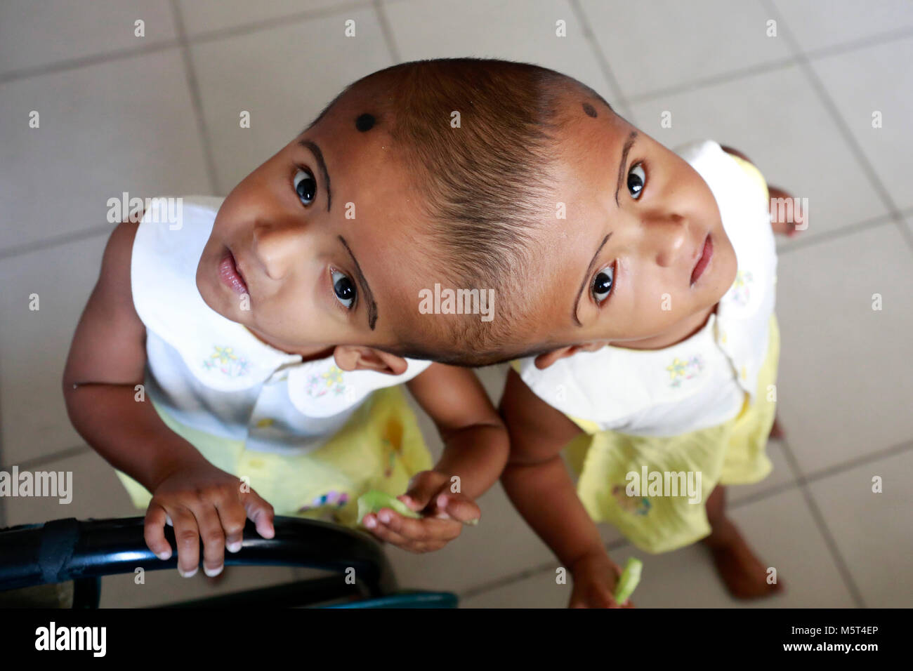 Dhaka, Bangladesh. 26 Février, 2018. Lits jumeaux siamois filles Rabeya l'Islam et l'Islam Rokeya jouer dans un hôpital à Dhaka, au Bangladesh. Taslima Khatun, professeur d'école, a donné une naissance de jumeaux siamois le dirigé le 16 juillet 2016 après une césarienne. Les jumeaux ont été admis à Dhaka medical college hospital pour examen avant la chirurgie potentiellement à séparer leurs têtes. Credit : SK Hasan Ali/Alamy Live News Banque D'Images