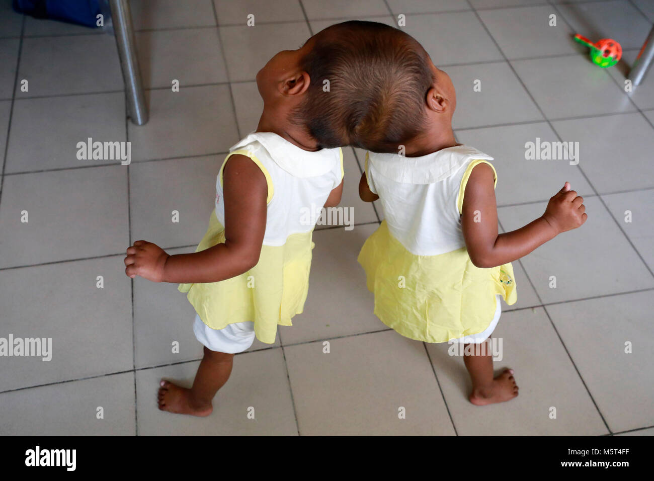 Dhaka, Bangladesh. 26 Février, 2018. Lits jumeaux siamois filles Rabeya l'Islam et l'Islam Rokeya jouer dans un hôpital à Dhaka, au Bangladesh. Taslima Khatun, professeur d'école, a donné une naissance de jumeaux siamois le dirigé le 16 juillet 2016 après une césarienne. Les jumeaux ont été admis à Dhaka medical college hospital pour examen avant la chirurgie potentiellement à séparer leurs têtes. Credit : SK Hasan Ali/Alamy Live News Banque D'Images