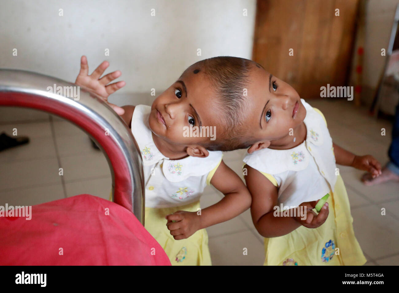 Dhaka, Bangladesh. 26 Février, 2018. Lits jumeaux siamois filles Rabeya l'Islam et l'Islam Rokeya jouer dans un hôpital à Dhaka, au Bangladesh. Taslima Khatun, professeur d'école, a donné une naissance de jumeaux siamois le dirigé le 16 juillet 2016 après une césarienne. Les jumeaux ont été admis à Dhaka medical college hospital pour examen avant la chirurgie potentiellement à séparer leurs têtes. Credit : SK Hasan Ali/Alamy Live News Banque D'Images