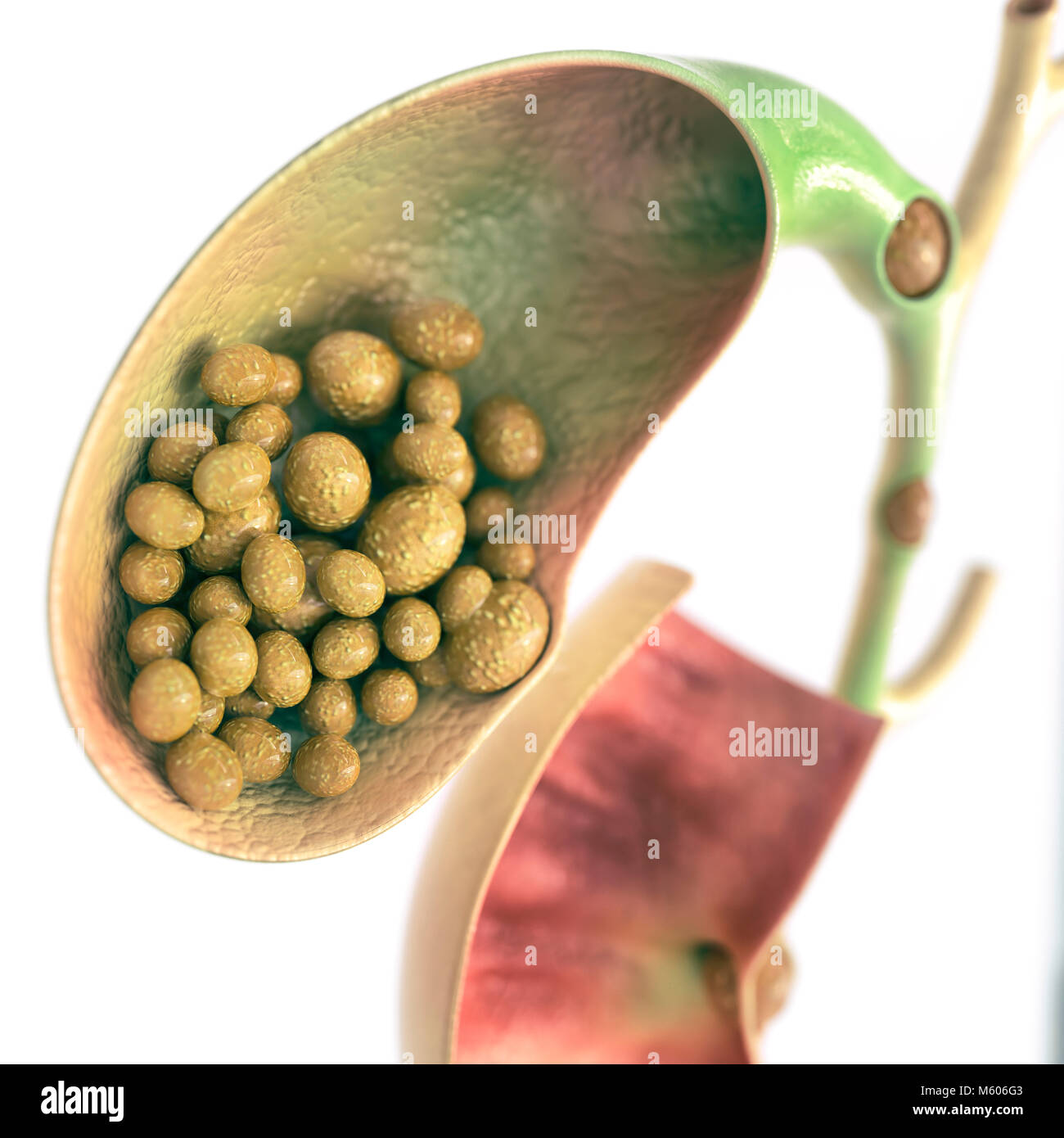Les calculs biliaires dans la vésicule biliaire et le canal cholédoque - haut de rendu 3D - Détails Banque D'Images