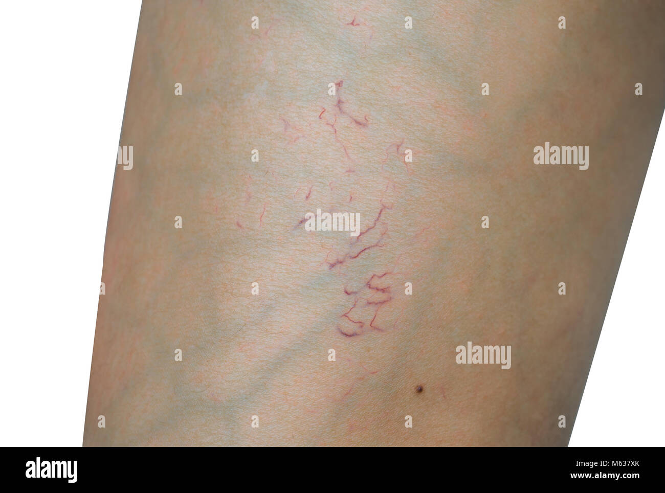 Plan Macro sur les varicosités sur jambe femme peau sur fond blanc. Concept avant la sclérothérapie ou la chirurgie au laser pour enlever les varicosités. Les varicosités n Banque D'Images