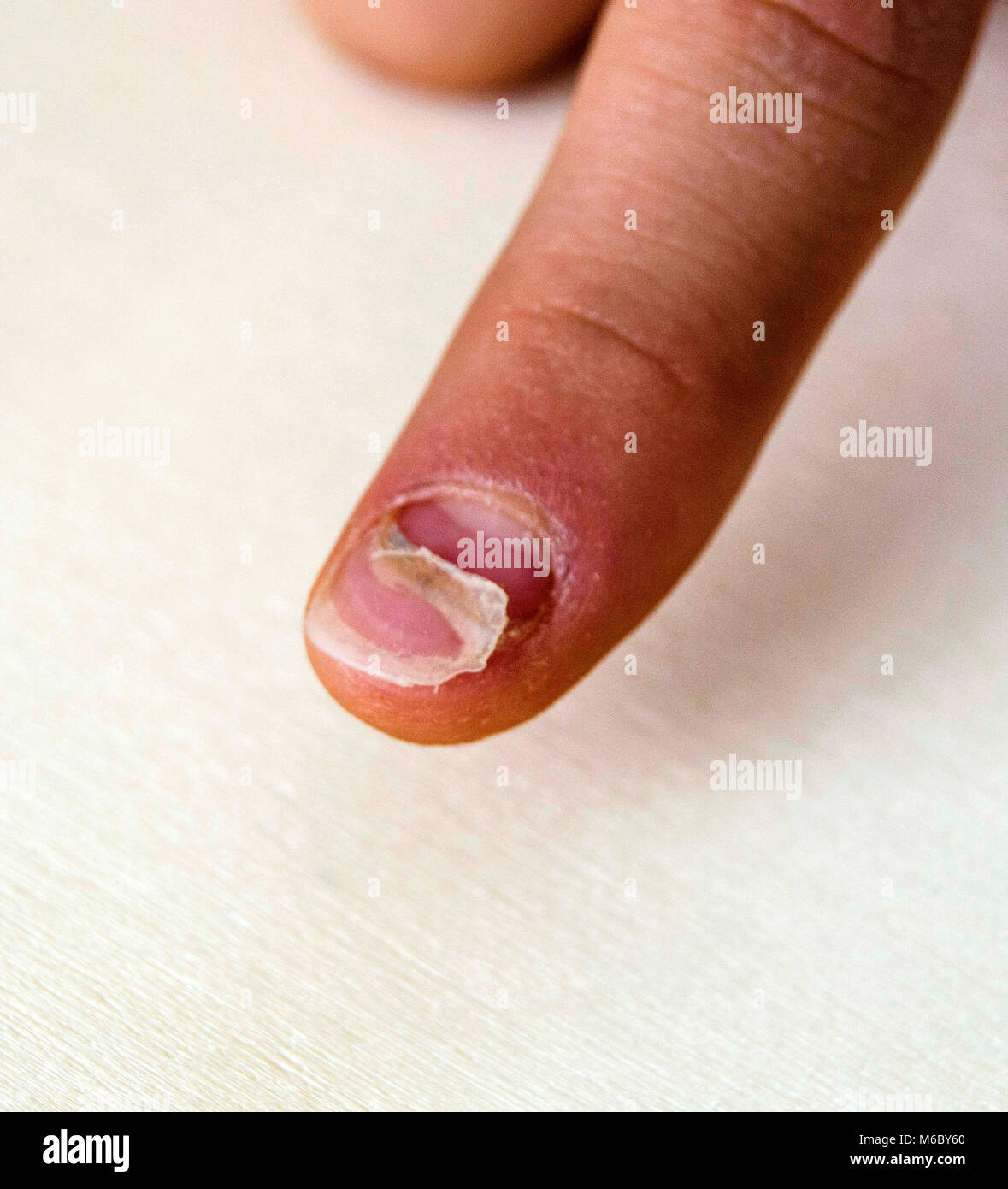 Maladie Des Ongles De Main Banque D Image Et Photos Alamy