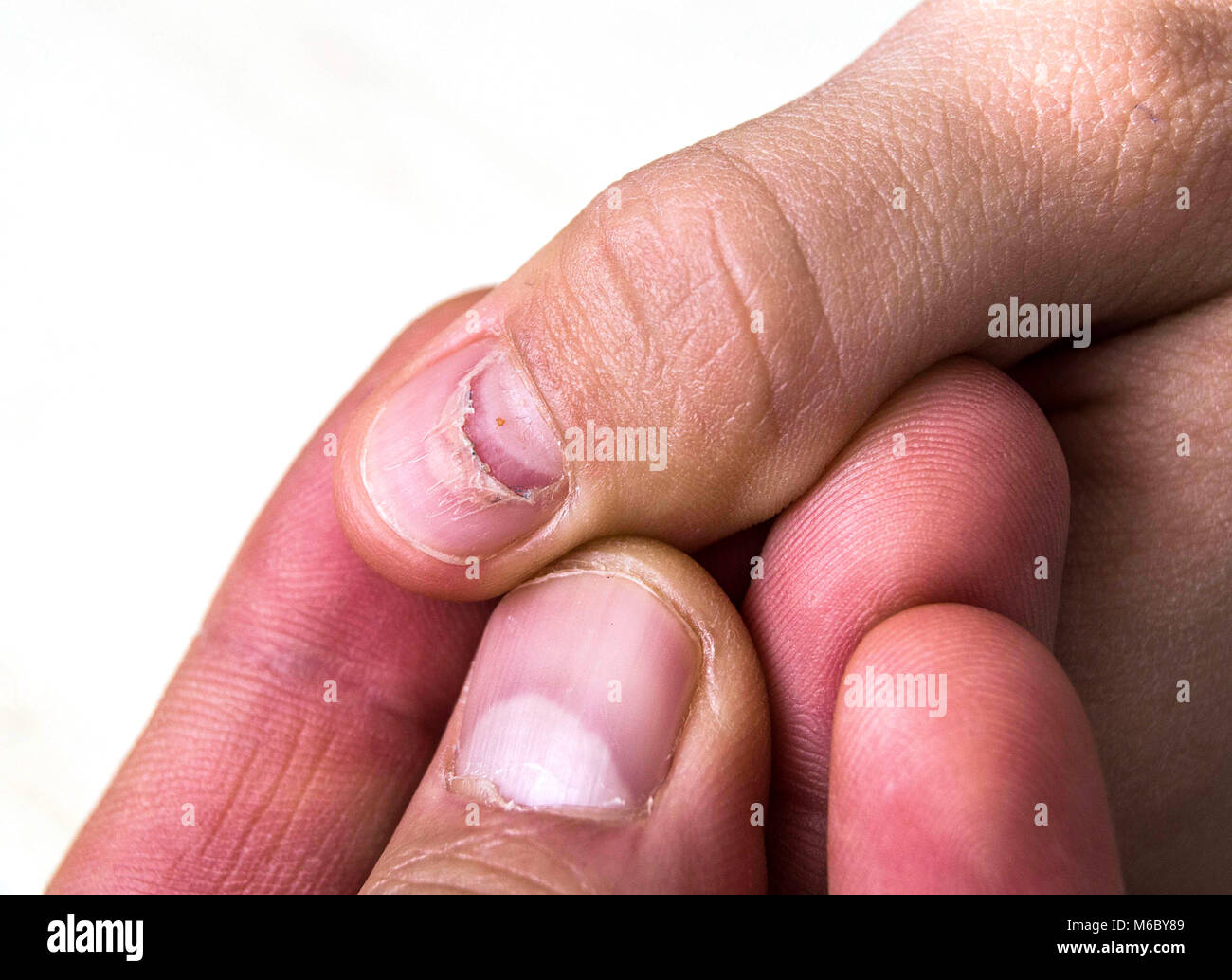 Le clou dans la repousse des ongles,enfants chute de bébé, ré-émergence des  ongles Mains, pieds et ongles main maladie baisse Photo Stock - Alamy