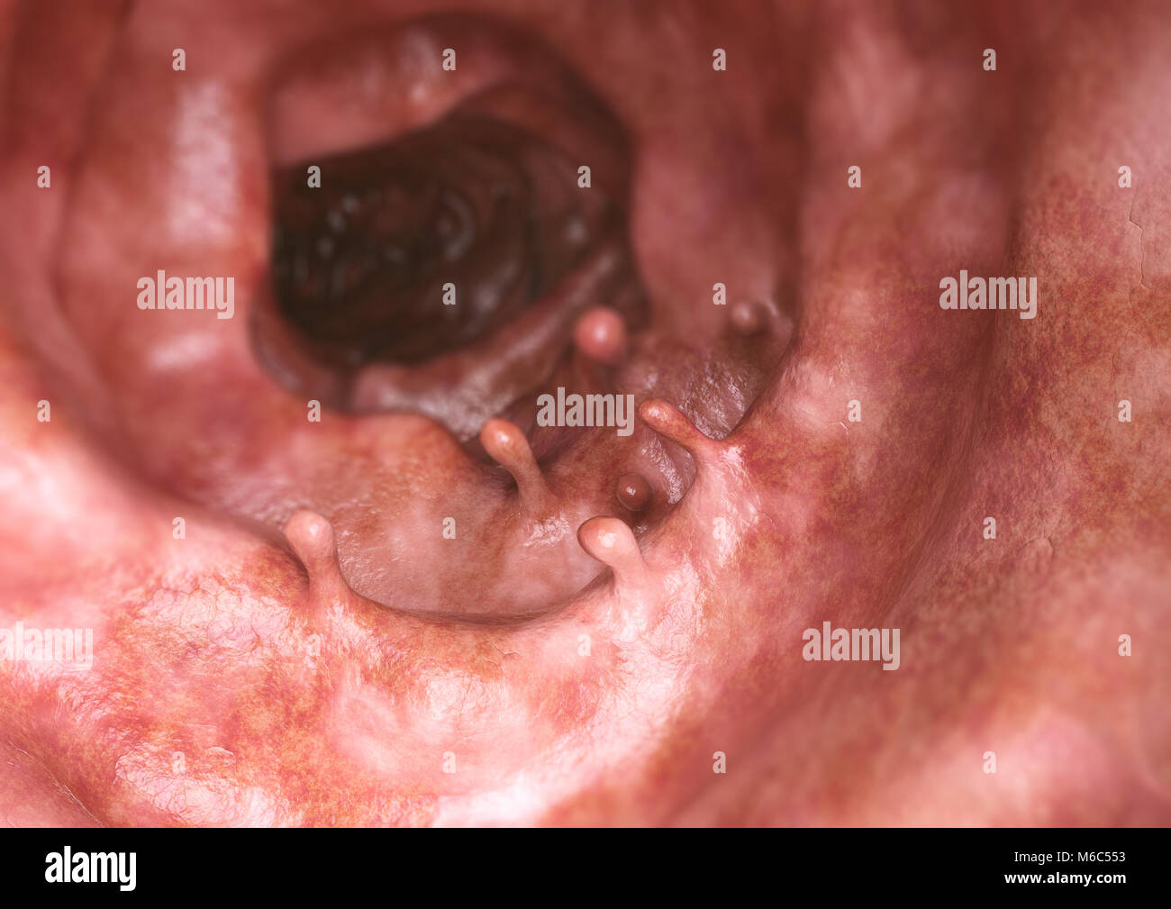 Polypes intestinaux libre - le rendu 3D Banque D'Images