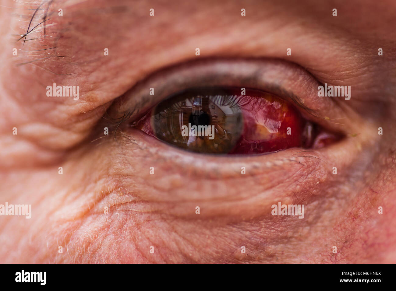 Rever De Perdre Un Oeil Les yeux injectés de sang causée par un accident industriel. Couper à l
