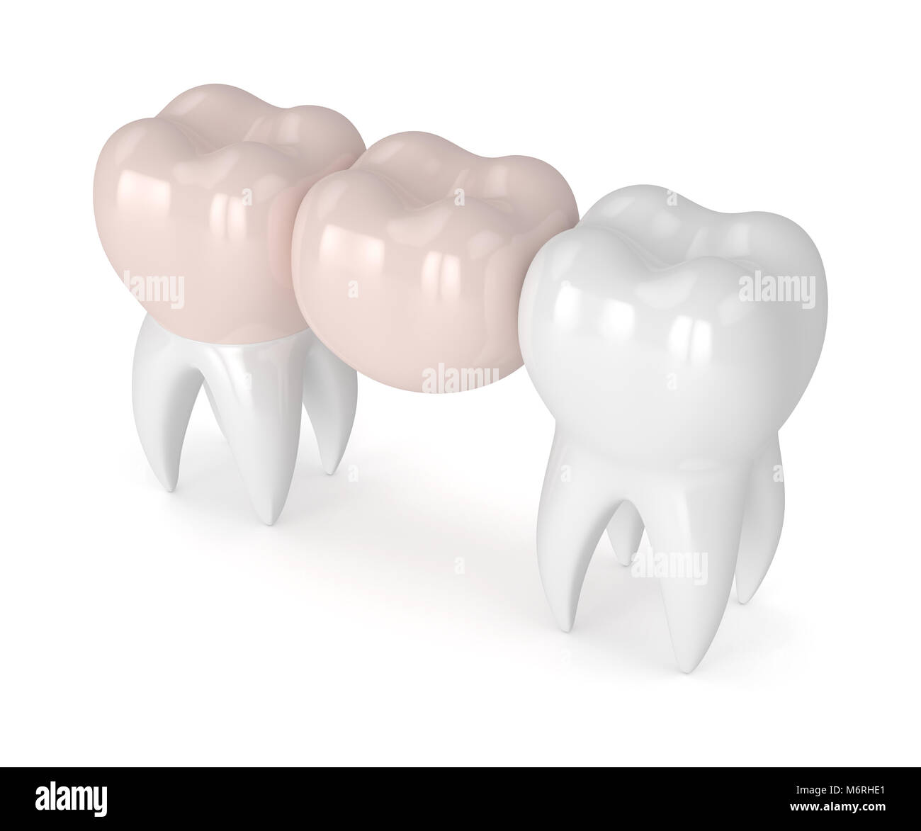 3D render de dents avec dental pont cantilever isolated over white background Banque D'Images