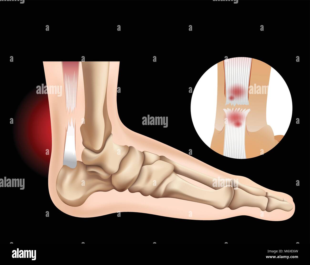 Pied humain avec tendon tear illustration Illustration de Vecteur
